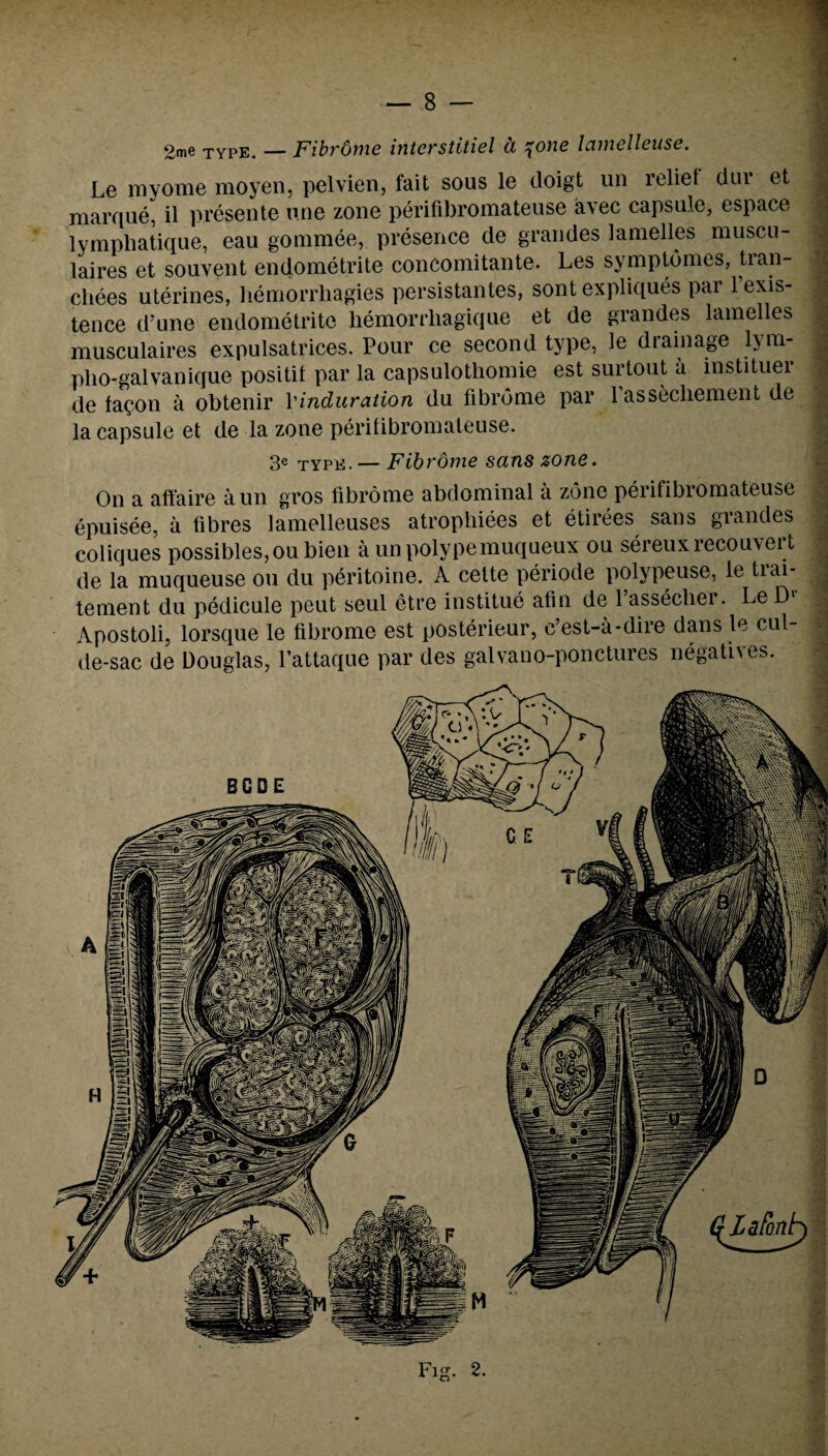 2me type. — Fibrdme interstitiel a \one lamelleuse. Le mvome moyen. pelvien, fait sous le doigt un relief dui* et marque, il presente nne zone perifibromateuse avec capsule, espace lympliatique, eau gommee, presence de grandes lamelles muscu- laires et souvent endometrite concomitante. Les symptomes, tran- chees uterines, hemorrliagies persistantes, sontexpliques par 1 exis¬ tence d’une endometrite liemorrliagique et de grandes lamelles musculaires expulsatrices. Pour ce second type, le diainage l>m- plio-galvanique positit par la capsulothomie est surtout a instituer de tagon a obtenir Vinduration du fibrome par l’assechement de la capsule et de la zone peritibromateuse. 3e type. — Fibrome sans zone. On a affaire aun gros fibrome abdominal a zone perifibromateuse epuisee, a fibres lamelleuses atrophiees et etirees sans grandes coliques possibles,ou bien a unpolypemuqueux ou sereuxrecouvert de la muqueuse ou du peritoine. A cette periode polypeuse, le trai- tement du pedicule peut seul etre institue afin de 1 asseclier. Le Dl Apostoli, lorsque le fibrome est posterieur, c’est-a-dire dans le cul- de-sac de Douglas, l’attaque par des galvano-ponctures negatiNes. Fig. 2.