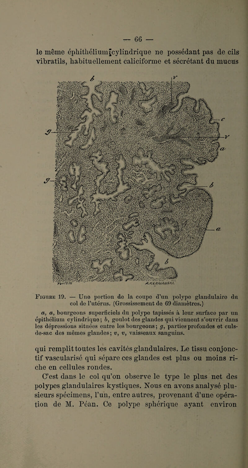 le même épliitliélium[cylindrique ne possédant pas de cils vibratils, habituellement caliciforme et sécrétant du mucus Figure 10. — Une portion de la coupe d’un polype glandulaire du col de l’utérus. (Grossissement de 69 diamètres.) a, a, bourgeons superficiels du polype tapissés à leur surface par un épithélium cylindrique; b, goulot des glandes qui viennent s’ouvrir dans les dépressions situées entre les bourgeons ; g, parties profondes et culs- de-sac des mêmes glandes; v, v, vaisseaux sanguins. qui remplit toutes les cavités glandulaires. Le tissu conjonc¬ tif vascularisé qui sépare ces glandes est plus ou moins ri¬ che en cellules rondes. C’est dans le col qu’on observe le type le plus net des polypes glandulaires kystiques. Nous en avons analysé plu¬ sieurs spécimens, l’un, entre autres, provenant d’une opéra¬ tion de M. Péan. Ce polype sphérique ayant environ