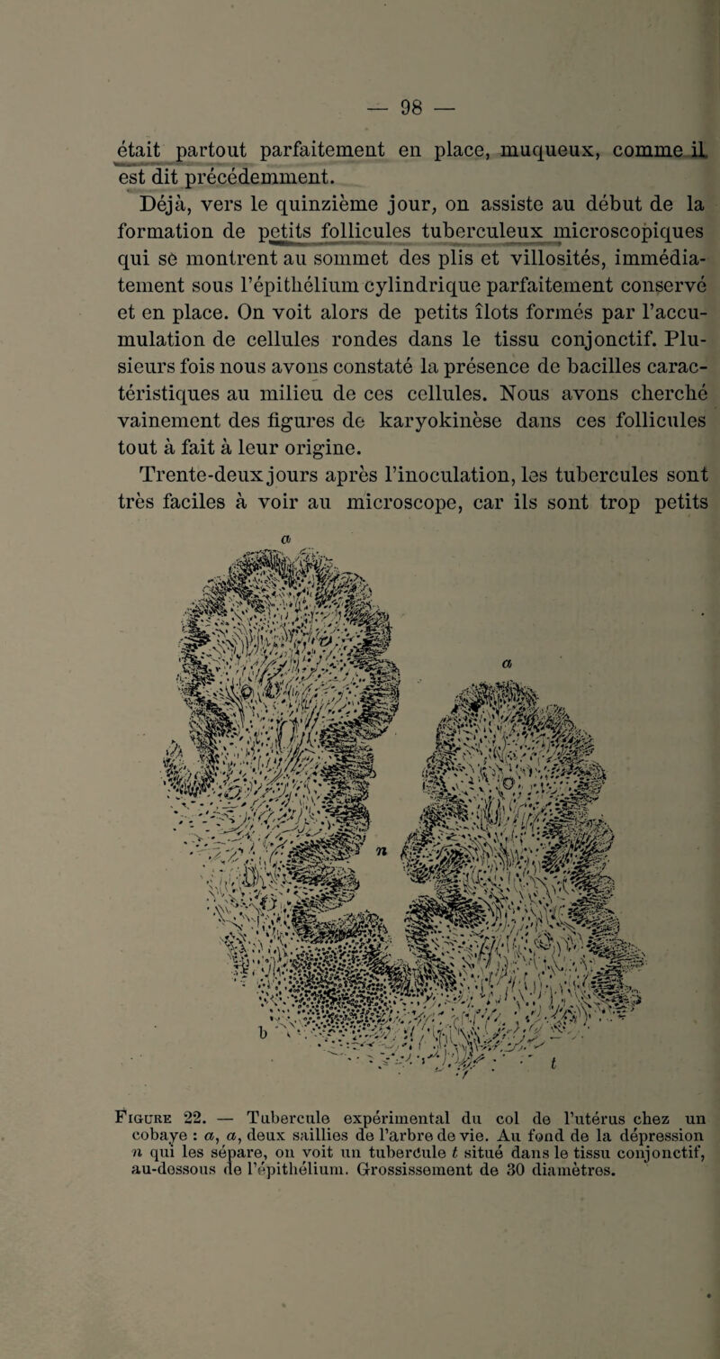 était partout parfaitement en place, muqueux, comme il est dit précédemment. Déjà, vers le quinzième jour, on assiste au début de la formation de petits follicules tuberculeux microscopiques qui se montrent au sommet des plis et villosités, immédia¬ tement sous l’épithélium cylindrique parfaitement conservé et en place. On voit alors de petits îlots formés par l’accu¬ mulation de cellules rondes dans le tissu conjonctif. Plu¬ sieurs fois nous avons constaté la présence de bacilles carac¬ téristiques au milieu de ces cellules. Nous avons cherché vainement des figures de karyokinèse dans ces follicules tout à fait à leur origine. Trente-deux jours après l’inoculation, les tubercules sont très faciles à voir au microscope, car ils sont trop petits Figure 22. — Tubercule expérimental du col de l’utérus chez un cobaye : «, deux saillies de l’arbre de vie. Au fond de la dépression n qui les sépare, on voit un tubercule t situé dans le tissu conjonctif, au-dessous de l’épithélium. Grossissement de 30 diamètres.