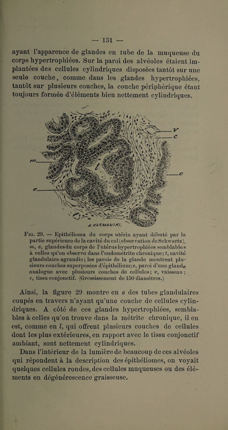 ayant l’apparence de glandes en tube de la muqueuse du corps hypertrophiées. Sur la paroi des alvéoles étaient im¬ plantées des cellules cylindriques disposées tantôt sur une seule couche, comme dans les glandes hypertrophiées, tantôt sur plusieurs couches, la couche périphérique étant toujours formée d’éléments bien nettement cylindriques. Fia. 29. — Epitliélioma du corps utérin ayant débuté par la partie supérieure de la cavité du col (observation de Sclnvartz). m. e, glandes du corps de l’utérus hypertrophiées semblables à celles qu’on observe dans l’endométrite chronique; t, cavité glandulaire agrandie; les parois de la glande montrent plu¬ sieurs couches superposées d’épithélium; e, paroi d’une glande analogue avec plusieurs couches de cellules; v, vaisseau; c, tissu conjonctif. (Grossissement de 150 diamètres.) Ainsi, la figure 29 montre en e des tubes glandulaires coupés en travers n’ayant qu’une couche de cellules cylin¬ driques. A côté de ces glandes hypertrophiées, sembla¬ bles à celles qu'on trouve dans la métrite chronique, il en est, comme en Z, qui offrent plusieurs couches de cellules dont les plus extérieures, en rapport avec le tissu conjonctif ambiant, sont nettement cylindriques. Dans l’intérieur de la lumière de beaucoup de ces alvéoles qui répondent à la description des épithéliomes, on voyait quelques cellules rondes, des cellules muqueuses ou des élé¬ ments en dégénérescence graisseuse.