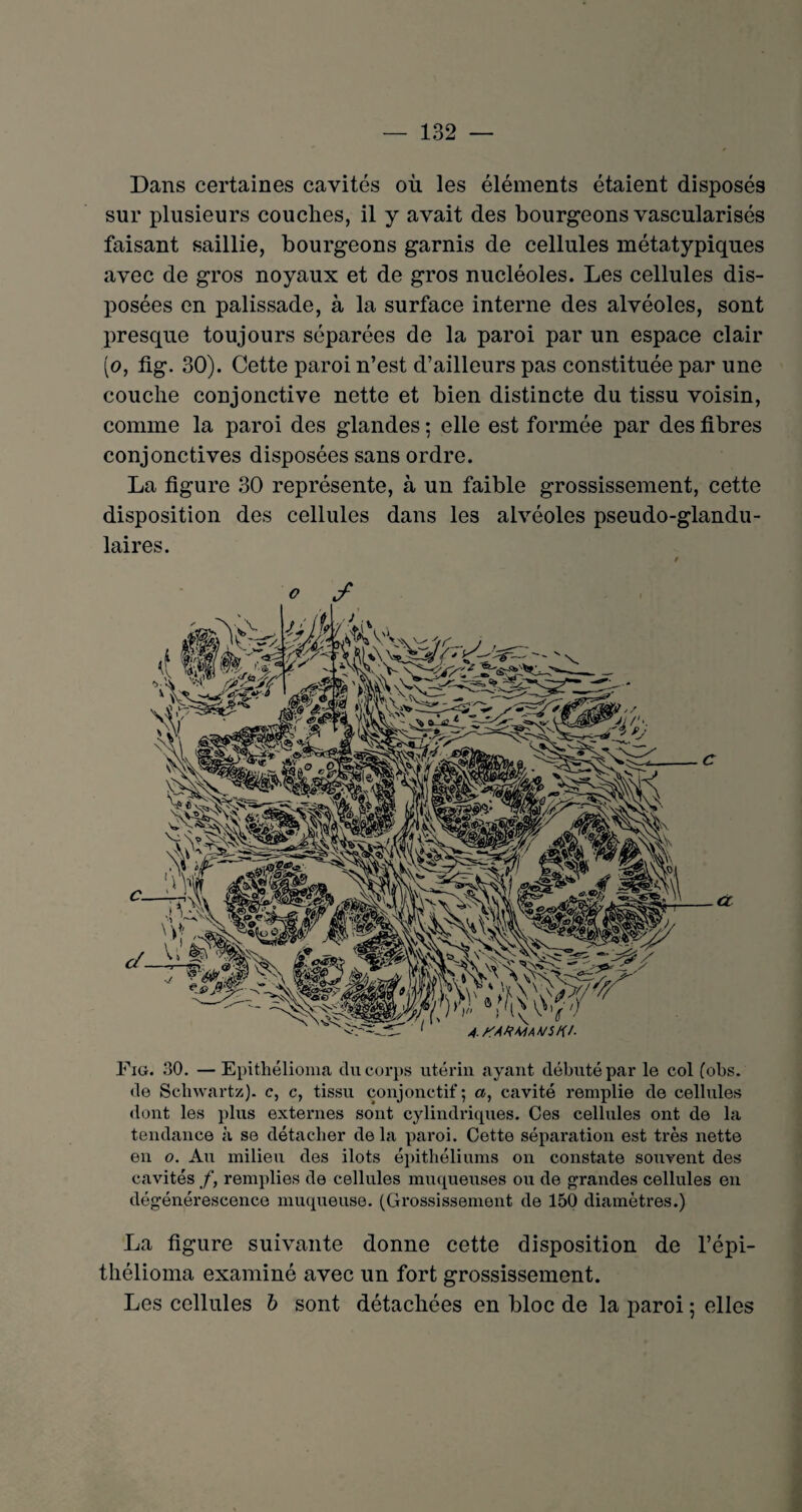 Dans certaines cavités où les éléments étaient disposés sur plusieurs couches, il y avait des bourgeons vascularisés faisant saillie, bourgeons garnis de cellules métatypiques avec de gros noyaux et de gros nucléoles. Les cellules dis¬ posées en palissade, à la surface interne des alvéoles, sont presque toujours séparées de la paroi par un espace clair (o, fig. 30). Cette paroi n’est d’ailleurs pas constituée par une couche conjonctive nette et bien distincte du tissu voisin, comme la paroi des glandes ; elle est formée par des fibres conjonctives disposées sans ordre. La figure 30 représente, à un faible grossissement, cette disposition des cellules dans les alvéoles pseudo-glandu¬ laires. o y Fig. 30. — Epithélioma clu corps utérin ayant débuté par le col (obs. de Schwartz), c, c, tissu conjonctif ; a, cavité remplie de cellules dont les plus externes sont cylindriques. Ces cellules ont de la tendance à se détacher de la paroi. Cette séparation est très nette en o. Au milieu des ilôts épithéliums on constate souvent des cavités f, remplies de cellules muqueuses ou de grandes cellules en dégénérescence muqueuse. (Grossissement de 150 diamètres.) La figure suivante donne cette disposition de l’épi- thélioma examiné avec un fort grossissement. Les cellules b sont détachées en bloc de la paroi ; elles