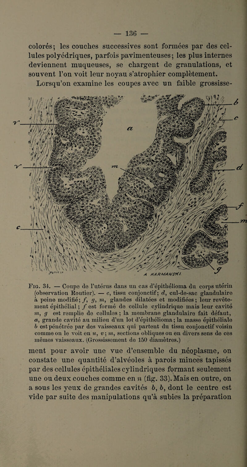 colorés; les couches successives sont formées par des cel¬ lules polyédriques, parfois pavimenteuses ; les plus internes deviennent muqueuses, se chargent de granulations, et souvent l’on voit leur noyau s’atrophier complètement. Lorsqu’on examine les coupes avec un faible grossisse- Fig. 34. — Coupe de l’utérus dans un cas d’épitliélioma du corps utérin (observation Routier). — c, tissu conjonctif; d, cul-de-sac glandulaire à peine modifié; /, g, m, glandes dilatées et modifiées; leur revête¬ ment épithélial ; f est formé de cellule cylindrique mais leur cavité w, g est remplie de cellules ; la membrane glandulaire fait défaut, «, grande cavité au milieu d’un lot d’épithélioma ; la masse épithéliale b est pénétrée par des vaisseaux qui partent du tissu conjonctif voisin comme on le voit en «, m, sections obliques ou en divers sens de ces mêmes vaisseaux. (Grossissement de 150 diamètres.) ment pour avoir une vue d’ensemble du néoplasme, on constate une quantité d’alvéoles à parois minces tapissés par des cellules épithéliales cylindriques formant seulement une ou deux couches comme en n (fig. 33). Mais en outre, on a sous les yeux de grandes cavités b, b, dont le centre est vide par suite des manipulations qu’à subies la préparation