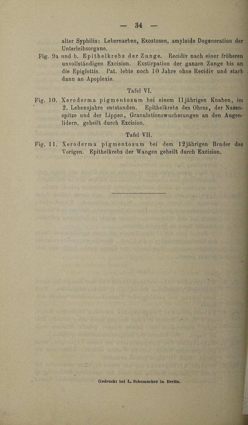 alter Syphilis: Lebernarben, Exostoson, amyloide Degeneration der Unterleibsorgane. Fig. 9a and b. Epithelkrebs derZange. Recidiv nach einer friiheren unvollstandigen Excision. Exstirpation der ganzen Zunge bis an die Epiglottis. Pat. lebte noch 10 Jahre ohne Recidiv und starb dann an Apoplexie. Tafel VI. Fig. 10. Xeroderma pigmentosum bei einem lljahrigen Knaben, im 2. Lebensjahre entstanden. Epithelkrebs des Ohres, der Nasen- spitze und der Lippen, Granulationswuchorungen an den Augen- lidern, geheilt durch Excision. Tafel VII. Fig. 11. Xeroderma pigmentosum bei dem 12jahrigen Bruder des Vorigen. Epithelkrebs der Wangen geheilt durch Excision. \. Gedruckt bei L. Schumacher in Berlin.