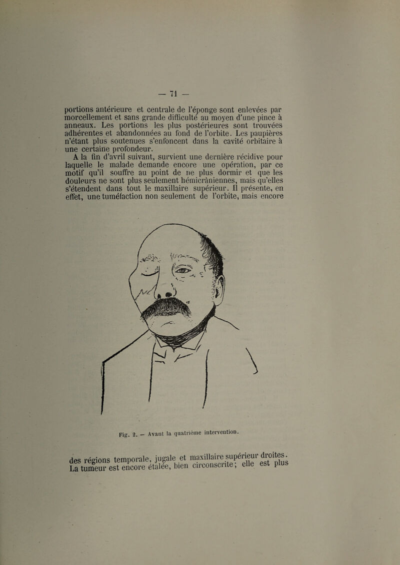 portions antérieure et centrale de l’éponge sont enlevées par morcellement et sans grande difficulté au moyen d’une pince à anneaux. Les portions les plus postérieures sont trouvées adhérentes et abandonnées au fond de l’orbite. Les paupières n’étant plus soutenues s’enfoncent dans la cavité orbitaire à une certaine profondeur. A la fin d’avril suivant, survient une dernière récidive pour laquelle le malade demande encore une opération, par ce motif qu’il souffre au point de ne plus dormir et que les douleurs ne sont plus seulement hémicrâniennes, mais qu’elles s’étendent dans tout le maxillaire supérieur. Il présente, en effet, une tuméfaction non seulement de l’orbite, mais encore pjg> 2. — Avant la quatrième intervention. des régions temporale, jugale et maxillaire supérieur droites. La tumeur est encore étalee, bien circonscnte, elle p