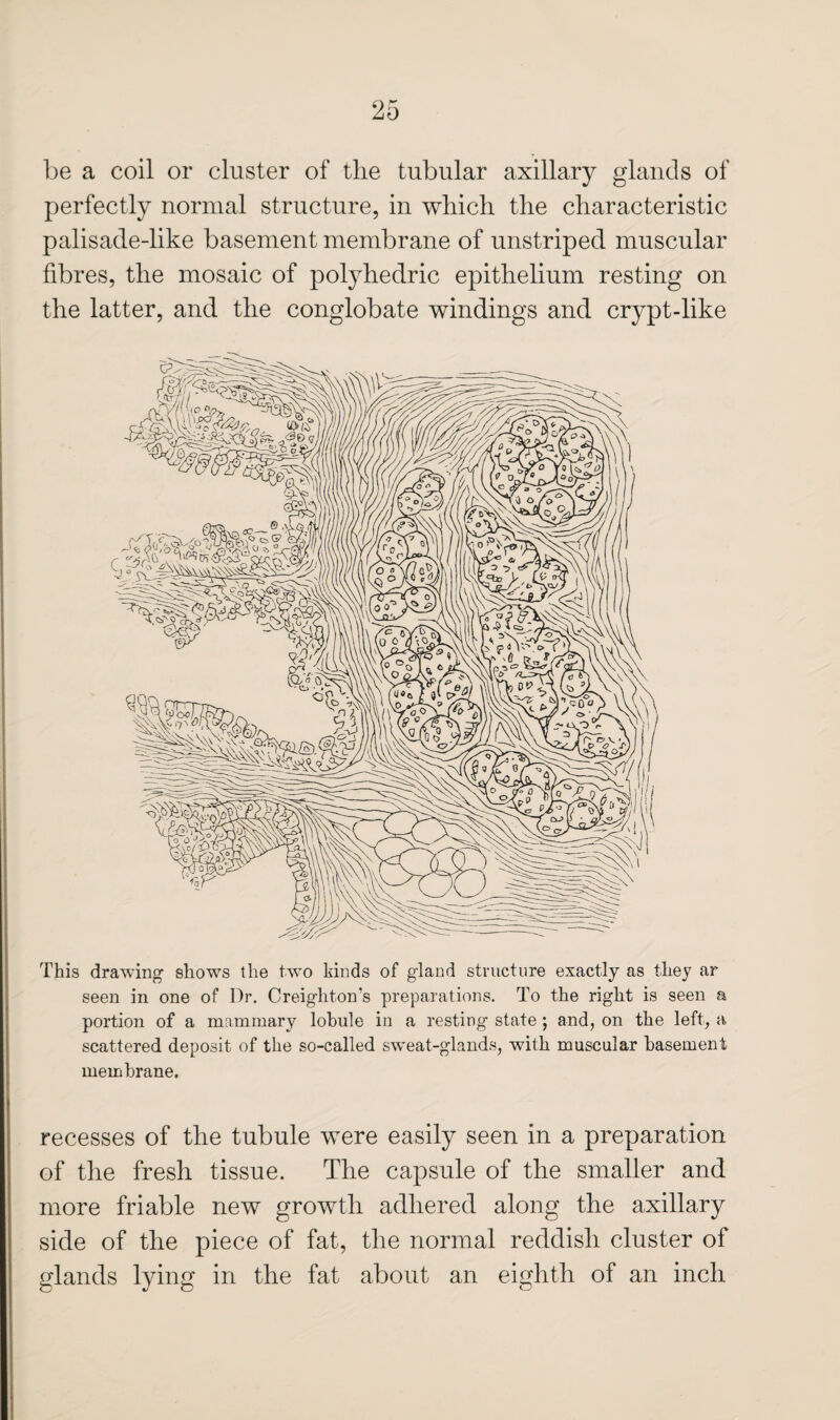 be a coil or cluster of the tubular axillary glands of perfectly normal structure, in which the characteristic palisade-like basement membrane of unstriped muscular fibres, the mosaic of polyhedric epithelium resting on the latter, and the conglobate windings and crypt-like This drawing shows the two kinds of gland structure exactly as they ar seen in one of Dr. Creighton’s preparations. To the right is seen a portion of a mammary lobule in a resting state ; and, on the left, a scattered deposit of the so-called sweat-glands, with muscular basement membrane. recesses of the tubule were easily seen in a preparation of the fresh tissue. The capsule of the smaller and more friable new growth adhered along the axillary side of the piece of fat, the normal reddish cluster of glands lying in the fat about an eighth of an inch