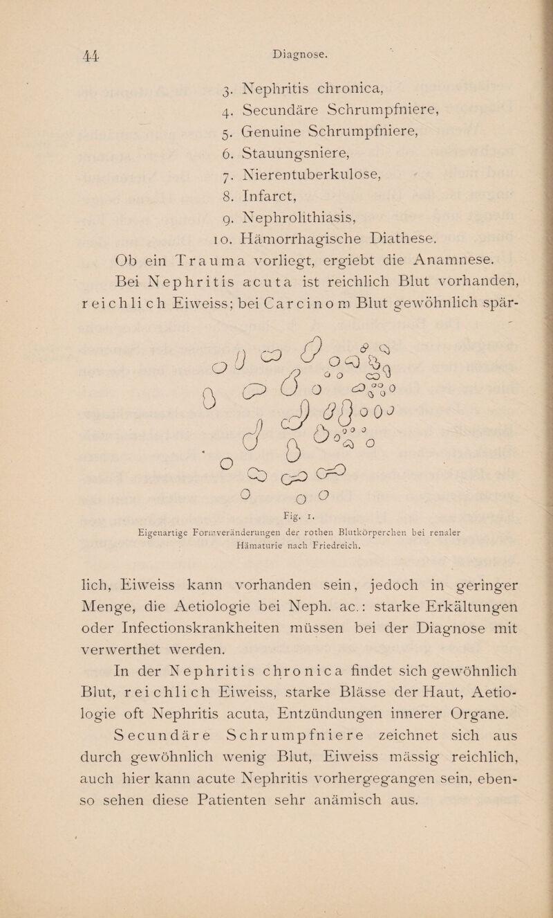 3. Nephritis chronica, 4. Secundäre Schrumpfniere, 5. Genuine Schrumpfniere, 6. Stauungsniere, 7. Nieren tuberkulöse, 8. Infarct, 9. Nephrolithiasis, 10. Hämorrhagische Diathese. Ob ein Trauma vorliegt, ergiebt die Anamnese. Bei Nephritis acuta ist reichlich Blut vorhanden, reichli cli Eiweiss; bei Car ein o m Blut gewöhnlich spär- S) O0b O o o Fig. 1. D Eigenartige Formveränderungen der rothen Blutkörperchen bei renaler Hämaturie nach Friedreich. lieh, Eiweiss kann vorhanden sein, jedoch in geringer Menge, die Aetiologie bei Neph. ac.: starke Erkältungen oder Infectionskrankheiten müssen bei der Diagnose mit verwerthet werden. In der Nephritis chronica findet sich gewöhnlich Blut, reichlich Eiweiss, starke Blässe der Haut, Aetio¬ logie oft Nephritis acuta, Entzündungen innerer Organe. Secundäre Schrumpfniere zeichnet sich aus durch gewöhnlich wenig Blut, Eiweiss mässig reichlich, auch hier kann acute Nephritis vorhergegangen sein, eben¬ so sehen diese Patienten sehr anämisch aus.