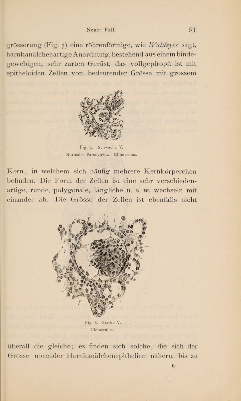 grösserung (Fig. 7) eine röhrenförmige, wie Waldeycr sagt, harnkanälchenartige Anordnung, bestehend aus einem binde¬ gewebigen, sehr zarten Gerüst, das vollgepfropft ist mit epitheloiden Zellen von bedeutender Grösse mit grossem Fig. 5. Schwache V. Normales Parenchym. Glomerulns. Kern , in welchem sich häufig mehrere Kernkörperchen befinden. Die Form der Zellen ist eine sehr verschieden¬ artige, runde, polygonale, längliche u. s. w. wechseln mit einander ab. Die Grösse der Zellen ist ebenfalls nicht Fig. 6. Starke V. Glomerulns. überall die gleiche; es finden sich solche, die sich der Grösse normaler Flarnkanälchenepithelien nähern, bis zu G