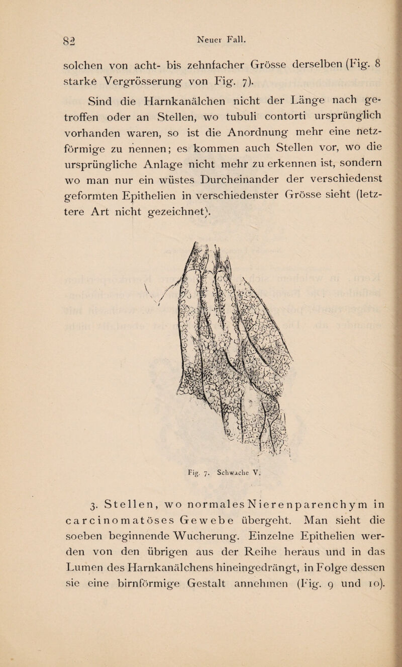 solchen von acht- bis zehnfacher Grösse derselben (Fig. 8 starke Vergrösserung von Fig. 7). Sind die Harnkanälchen nicht der Länge nach ge¬ troffen oder an Stellen, wo tubuli contorti ursprünglich vorhanden waren, so ist die Anordnung mehr eine netz¬ förmige zu nennen; es kommen auch Stellen vor, wo die ursprüngliche Anlage nicht mehr zu erkennen ist, sondern wo man nur ein wüstes Durcheinander der verschiedenst geformten Epithelien in verschiedenster Grösse sieht (letz¬ tere Art nicht gezeichnet). Fig. 7. Schwache V. 3. Stellen, wo normales Niere np arenchy m in carcinomatöses Gewebe übergeht. Man sieht die soeben beginnende Wucherung. Einzelne Epithelien wer¬ den von den übrigen aus der Reihe heraus und in das Lumen des Harnkanälchens hineingedrängt, in Folge dessen sie eine bimförmige Gestalt annehmen (Fig. 9 und 10).