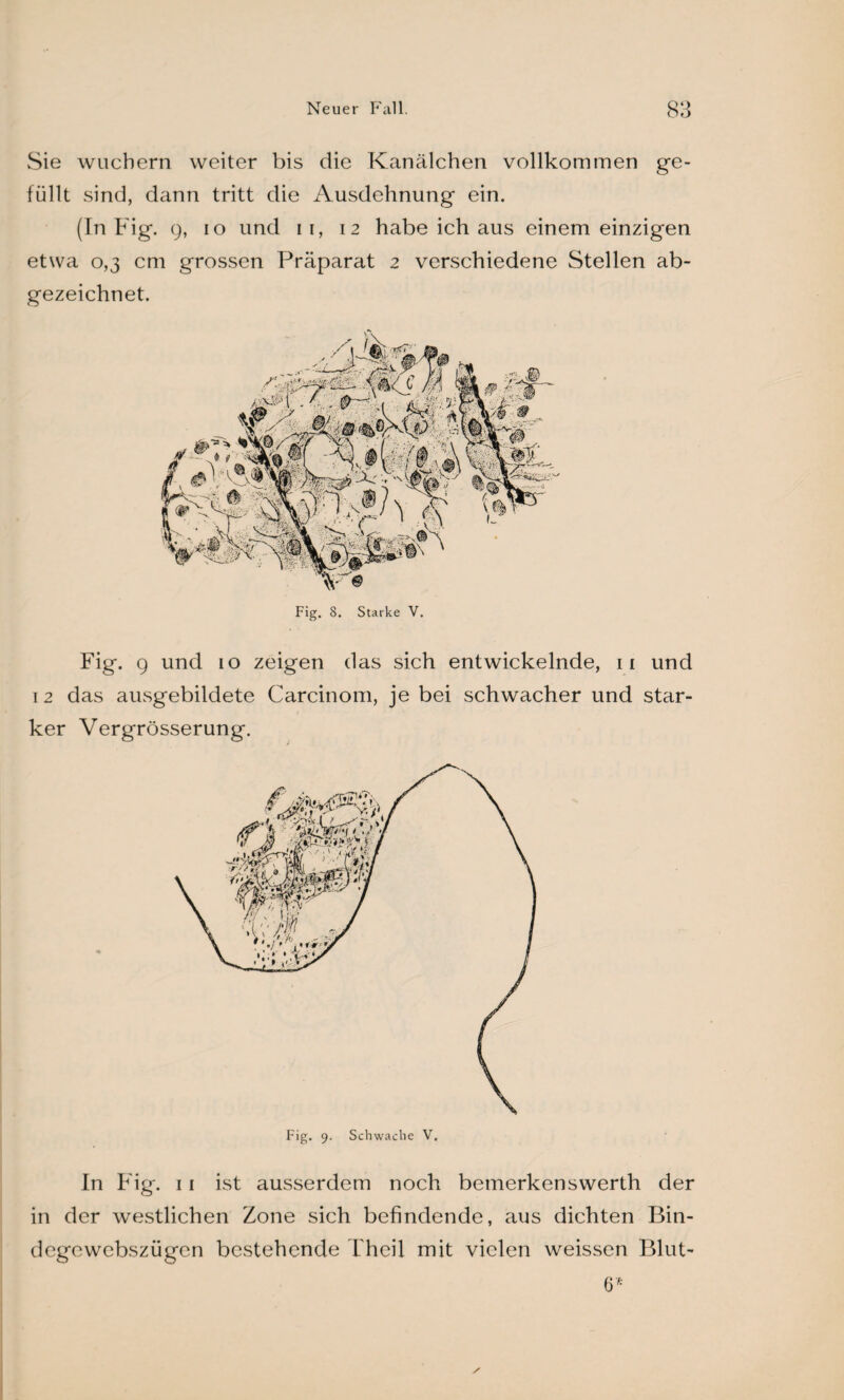 Sie wuchern weiter bis die Kanälchen vollkommen ge¬ füllt sind, dann tritt die Ausdehnung ein. (In Fig. 9, 10 und 11, 12 habe ich aus einem einzigen etwa 0,3 cm grossen Präparat 2 verschiedene Stellen ab¬ gezeichnet. Fig. 9 und 10 zeigen das sich entwickelnde, 11 und 12 das ausgebildete Carcinom, je bei schwacher und star¬ ker Vergrösserung. In Fig. 11 ist ausserdem noch bemerkenswerth der in der westlichen Zone sich befindende, aus dichten Bin- degewebszügcn bestehende Thcil mit vielen weissen Blut- 6* /