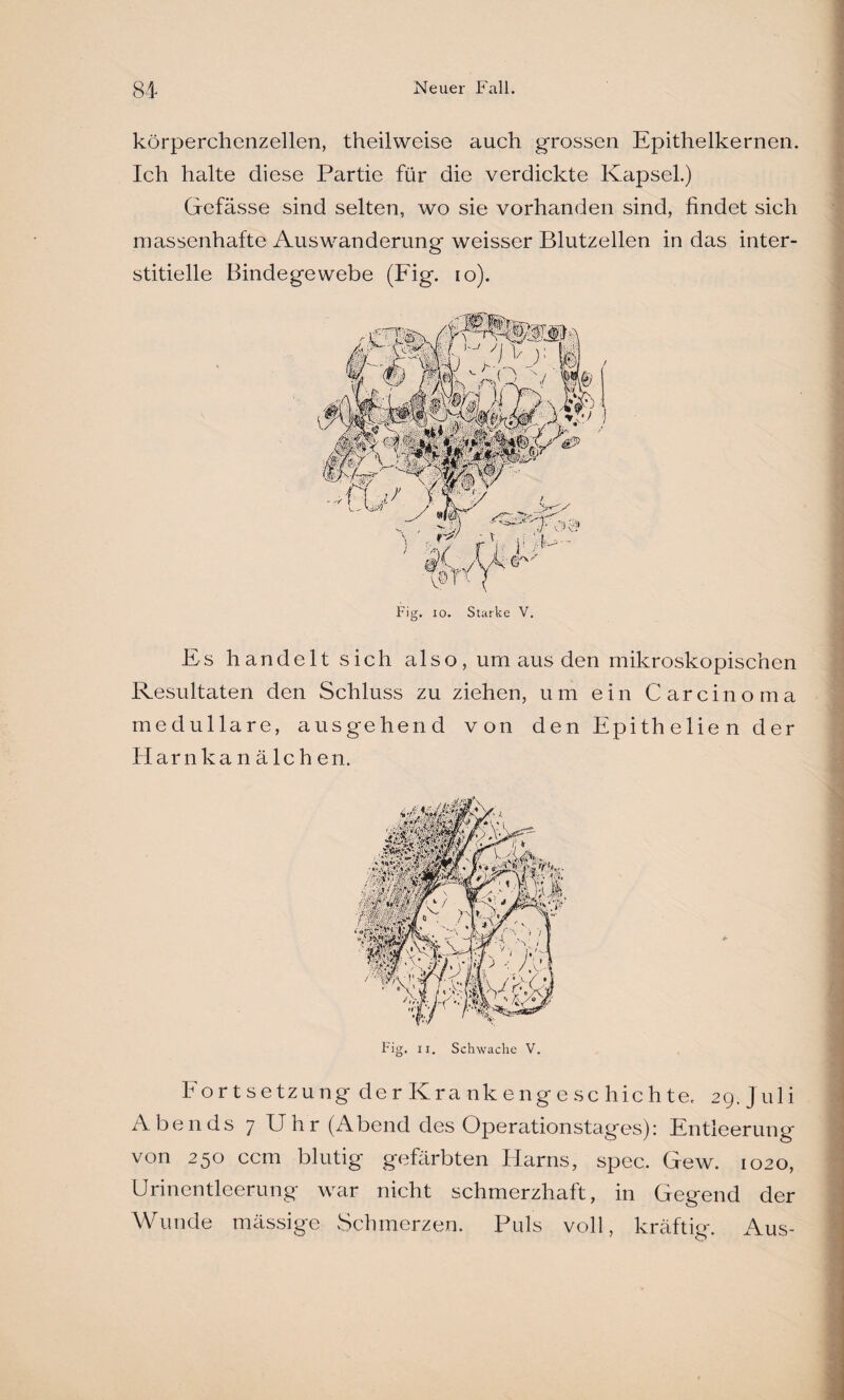 körperchenzellen, theilweise auch grossen Epithelkernen. Ich halte diese Partie für die verdickte Kapsel.) Gefässe sind selten, wo sie vorhanden sind, findet sich massenhafte Auswanderung weisser Blutzellen in das inter¬ stitielle Bindegewebe (Fig. io). Fig. io. Starke V. Es handelt sich also, um aus den mikroskopischen Resultaten den Schluss zu ziehen, um ein Carcinoma medulläre, ausgehend von denEpitheliender Harnkanälchen. Fortsetzung der Krankengeschichte. 29. Juli Abends 7 Uhr (Abend des Operationstages): Entleerung von 250 ccm blutig gefärbten Harns, spec. Gew. 1020, Urinentleerung war nicht schmerzhaft, in Gegend der Wunde mässige Schmerzen. Puls voll, kräftig. Aus-