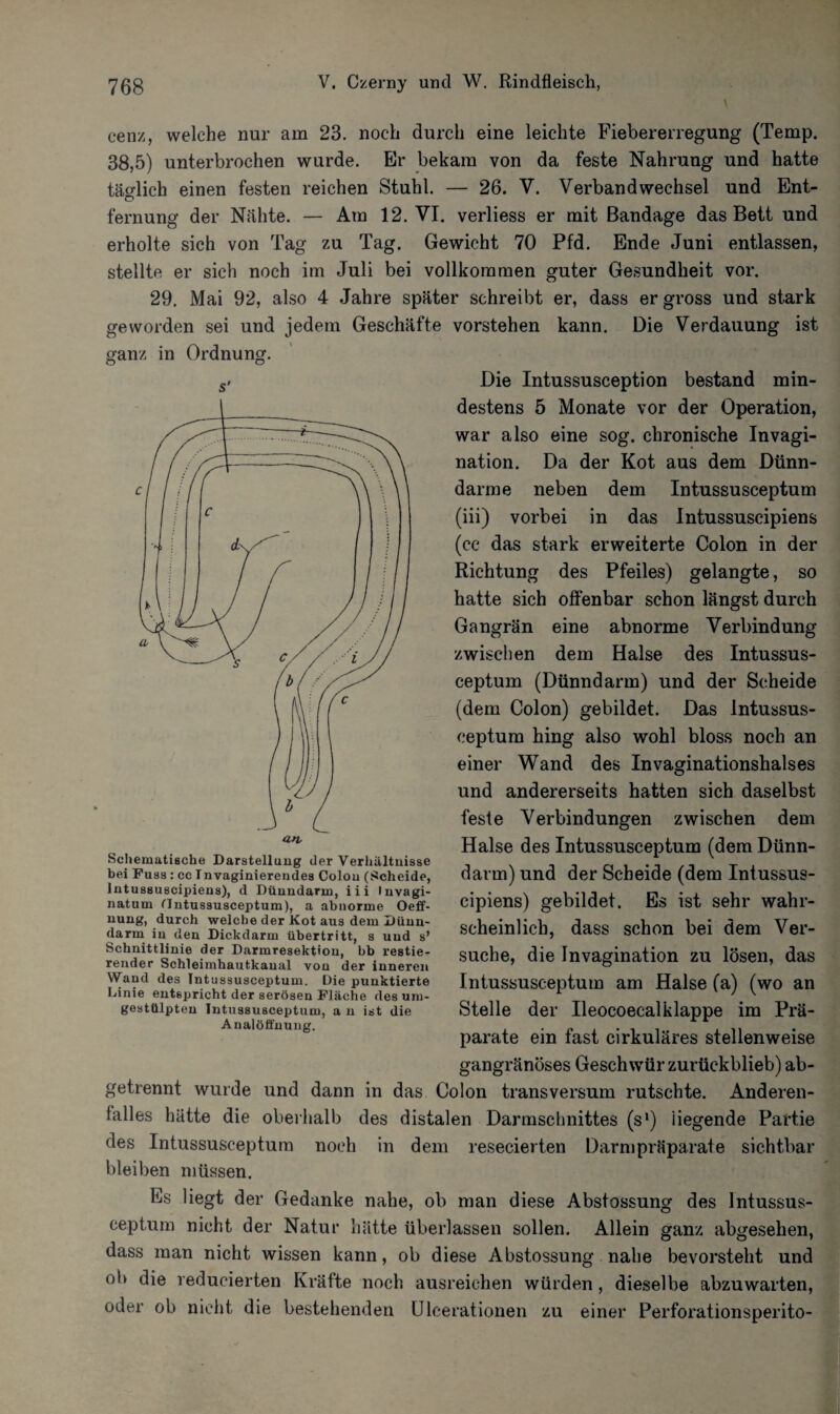 cenz, welche nur am 23. noch durch eine leichte Fiebererregung (Temp. 38,5) unterbrochen wurde. Er bekam von da feste Nahrung und hatte tätlich einen festen reichen Stuhl. — 26. V. Verbandwechsel und Ent- fernung der Nähte. — Am 12. VI. verliess er mit Bandage das Bett und erholte sich von Tag zu Tag. Gewicht 70 Pfd. Ende Juni entlassen, stellte er sich noch im Juli bei vollkommen guter Gesundheit vor. 29. Mai 92, also 4 Jahre später schreibt er, dass er gross und stark geworden sei und jedem Geschäfte vorstehen kann. Die Verdauung ist ganz in Ordnung. s' natum Hntussusceptum), a abnorme Oeff- durch welche der Kot aus dem Dünn¬ darm in den Dickdarm Übertritt, s und s’ Schnittlinie der Darmresektion, bb Testie¬ render Schleimhautkaual von der inneren Wand des Tntussusceptum. Die punktierte Linie entspricht der serösen Fläche des um¬ gestülpten Intussusceptum, a n ist die Analöffnung. Die Intussusception bestand min¬ destens 5 Monate vor der Operation, war also eine sog. chronische Invagi- nation. Da der Kot aus dem Dünn¬ därme neben dem Intussusceptum (iii) vorbei in das Intussuscipiens (cc das stark erweiterte Colon in der Richtung des Pfeiles) gelangte, so hatte sich offenbar schon längst durch Gangrän eine abnorme Verbindung zwischen dem Halse des Intussus¬ ceptum (Dünndarm) und der Scheide (dem Colon) gebildet. Das Intussus¬ ceptum hing also wohl bloss noch an einer Wand des Invaginationshalses und andererseits hatten sich daselbst feste Verbindungen zwischen dem Halse des Intussusceptum (dem Dünn¬ darm) und der Scheide (dem Intussus¬ cipiens) gebildet. Es ist sehr wahr¬ scheinlich, dass schon bei dem Ver¬ suche, die Invagination zu lösen, das Intussusceptum am Halse (a) (wo an Stelle der Ileocoecalklappe im Prä¬ parate ein fast cirkuläres stellenweise gangränöses Geschwür zurückblieb) ab¬ getrennt wurde und dann in das Colon transversum rutschte. Anderen- falles hätte die oberhalb des distalen Dannschnittes (sl) liegende Partie des Intussusceptum noch in dem resecierten Darmpräparate sichtbar bleiben müssen. Es liegt der Gedanke nahe, ob man diese Abstossung des Intussus¬ ceptum nicht der Natur hätte überlassen sollen. Allein ganz abgesehen, dass man nicht wissen kann, ob diese Abstossung nahe bevorsteht und ob die reducierten Kräfte noch ausreichen würden, dieselbe abzuwarten, oder ob nicht die bestehenden Ulcerationen zu einer Perforationsperito-