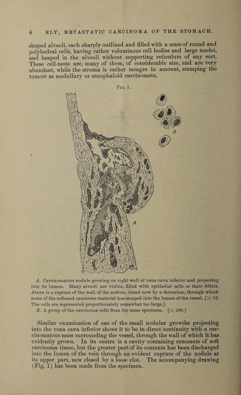 shaped alveoli, each sharply outlined and filled with a mass of round and polyhedral cells, having rather voluminous cell bodies and large nuclei, and heaped in the alveoli without supporting reticulum of any sort. These cell-nests are, many of them, of considerable size, and are very abundant, while the stroma is rather meagre in amount, stamping the tumors as medullary or encephaloid carcinomata. Fig. l. A. Carcinomatous nodule growing on right wall of vena cava inferior and projecting into its lumen. Many alveoli are visible, filled with epithelial cells or their debris. Above is a rupture of the wall of the nodule, closed now by a thrombus, through which some of the softened cancerous material has escaped into the lumen of the vessel. [X 12. The cells are represented proportionately somewhat too large.] B. A group of the carcinoma cells from the same specimen. [X 500.] Similar examination of one of the small nodular growths projecting into the vena cava inferior shows it to be in direct continuity with a car¬ cinomatous mass surrounding the vessel, through the wall of which it has evidently grown. In its centre is a cavity containing remnants of soft carcinoma tissue, but the greater part of its contents has been discharged into the lumen of the vein through an evident rupture of the nodule at its upper part, now closed by a loose clot. The accompanying drawing (Fig. 1) has been made from the specimen.