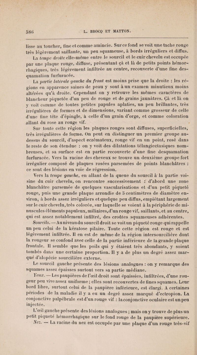 lisse au toucher, fineetcomme amincie. Surcefond se voit une tache rouge très légèrement saillante, un peu squameuse, à bords irréguliers et diffus. La tempe droite elle-même entre le sourcil et Je cuir chevelu est occupée par une plaque rouge, diffuse, présentant çà et là de petits points hémor¬ rhagiques, très légèrement infiltrée au centre, recouverte d’une fine des¬ quamation furfuracée. La partie latérale gauche du front est moins prise que la droite : les ré¬ gions en apparence saines de peau y sont à un examen minutieux moins alte'rées qu’à droite. Cependant on y retrouve les mêmes caractères de blancheur piquetée d’un peu de rouge et de grains jaunâtres. Çà et là on y voit comme de toutes petites papules aplaties, un peu brillantes, très irrégulières de formes et de dimensions, variant comme grosseur de celle d’une fine tête d’épingle, à celle d’un grain d’orge, et comme coloration allant du rose au rouge vif. Sur toute cette région les plaques rouges sont diffuses, superficielles, très irrégulières de forme. On peut en distinguer un premier groupe au- dessus du sourcil, d’aspect eczémateux, rouge vif en un point, rosé dans le reste de son étendue : on y voit des dilatations télangiectasiques nom¬ breuses, et sa surface est en partie recouverte d’une fine desquamation furfuracée. Vers la racine des cheveux se trouve un deuxième groupe fort irrégulier composé de plaques rosées parsemées de points blanchâtres : ce sont des lésions en voie de régression. Vers la tempe gauche, en allant de la queue du sourcil à la partie voi¬ sine du cuir chevelu, on rencontre successivement : d’abord une zone blanchâtre parsemée de quelques vascularisations et d’un petit piqueté rouge, puis une grande plaque arrondie de 5 centimètres de diamètre en¬ viron, à bords assez irréguliers et quelque peu diffus, empiétant largement sur le cuir chevelu, très colorée, sur laquelle se voient à la périphérie de mi¬ nuscules éléments papuleux, miliaires,d’un rouge vif, saillants, et au centre, qui est assez notablement infiltré, des croûtes squameuses adhérentes. Sourcils. — Auniveaudu sourcil droit se voitun piqueté rouge qui rappelle un peu celui de la kératose pilaire. Toute cette région est rouge et est légèrement infiltrée. Il en est de même de la région intersourcilière dont la rougeur se confond avec celle de la partie inférieure de la grande plaque frontale. 11 semble que les poils qui y étaient très abondants, y soient tombés dans une certaine proportion. Il y a de plus un degré assez mar¬ qué d’alopécie sourcilière externe. Le sourcil gauche présente des lésions analogues : on y remarque des squames assez épaisses surtout vers sa partie médiane. Yeux. — Les paupières de l’œil droit sont épaissies, infiltrées, d’une rou¬ geur peu vive assez uniforme ; elles sont recouvertes de fines squames. Leur bord libre, surtout celui de la paupière inférieure, est élargi. A certaines périodes de la maladie il y a eu un degré assez marqué d’ectropion. La conjonctive palpébrale estd’un rouge vif : laconjonctive oculaire est un peu injectée. L œil gauche présente des lésions analogues ; mais on y trouve de plus un petit piqueté hémorrhagique sur le fond rouge de la paupière supérieure. IVez. La racine du nez est occupée par une plaque d’un rouge très-vif