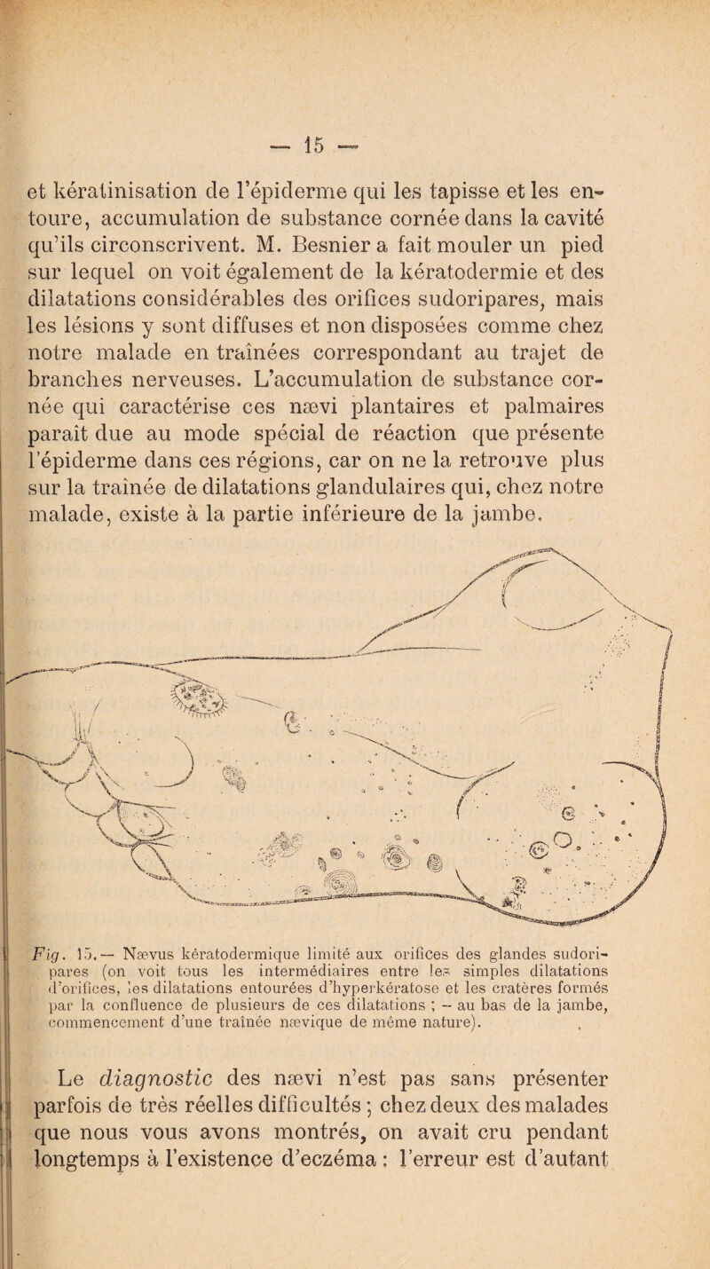 Fig. 15.— Naevus kêratodermique limité aux orifices des glandes sudori- pares (on voit tous les intermédiaires entre les simples dilatations d’orifices, les dilatations entourées d’hyperkératose et les cratères formés par la confluence de plusieurs de ces dilatations ; -- au bas de la jambe, commencement d’une traînée nævique de même nature). . Le diagnostic des nævi n’est pas sans présenter parfois de très réelles difficultés ; chez deux des malades : que nous vous avons montrés, on avait cru pendant longtemps à l’existence d’eczéma : l’erreur est d’autant et kératinisation de l’épiderme qui les tapisse et les en¬ toure, accumulation de substance cornée dans la cavité qu’ils circonscrivent. M. Besniera fait mouler un pied sur lequel on voit également de la kératodermie et des dilatations considérables des orifices sudoripares, mais les lésions y sont diffuses et non disposées comme chez notre malade en tramées correspondant au trajet de branches nerveuses. L’accumulation de substance cor¬ née qui caractérise ces nævi plantaires et palmaires paraît due au mode spécial de réaction que présente l’épiderme dans ces régions, car on ne la retrouve plus sur la tramée de dilatations glandulaires qui, chez notre malade, existe à la partie inférieure de la jambe.