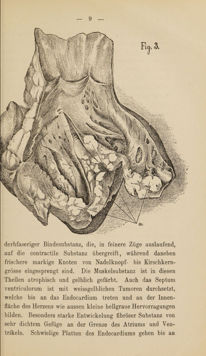 derbfaseriger Bindesubstanz, die, in feinere Züge auslaufend, auf die contractile Substanz übergreift, während daneben frischere markige Knoten von Nadelknopf- bis Kirschkern¬ grösse eingesprengt sind. Die Muskelsubstanz ist in diesen Theilen atrophisch und gelblich gefärbt. Auch das Septum ventriculorum ist mit weissgelblichen Tumoren durchsetzt, welche bis an das Endocardium treten und an der Innen¬ fläche des Herzens wie aussen kleine hellgraue Heryorragungen bilden. Besonders starke Entwickelung fibröser Substanz von sehr dichtem Gefüge an der Grenze des Atriums und Ven¬ trikels. Schwielige Platten des Endocardiums gehen bis an