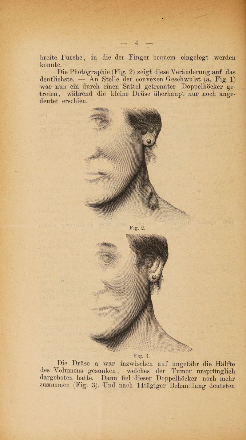 breite Furche, in die der Finger bequem eingelegt werden konnte. Die Photographie (Fig. 2) zeigt diese Veränderung auf das deutlichste. — An Stelle der convexen Geschwulst (a, Fig. 1) war nun ein durch einen Sattel getrennter Doppelhöcker ge¬ treten , während die kleine Drüse überhaupt nur noch ange¬ deutet erschien. Fig. 3. Die Drüse a war inzwischen auf ungefähr die Hälfte des Volumens gesunken, welches der Tumor ursprünglich dargeboten hatte. Dann fiel dieser Doppelhöcker noch mehr zusammen (Fig. 3). Und nach 14tägiger Behandlung deuteten