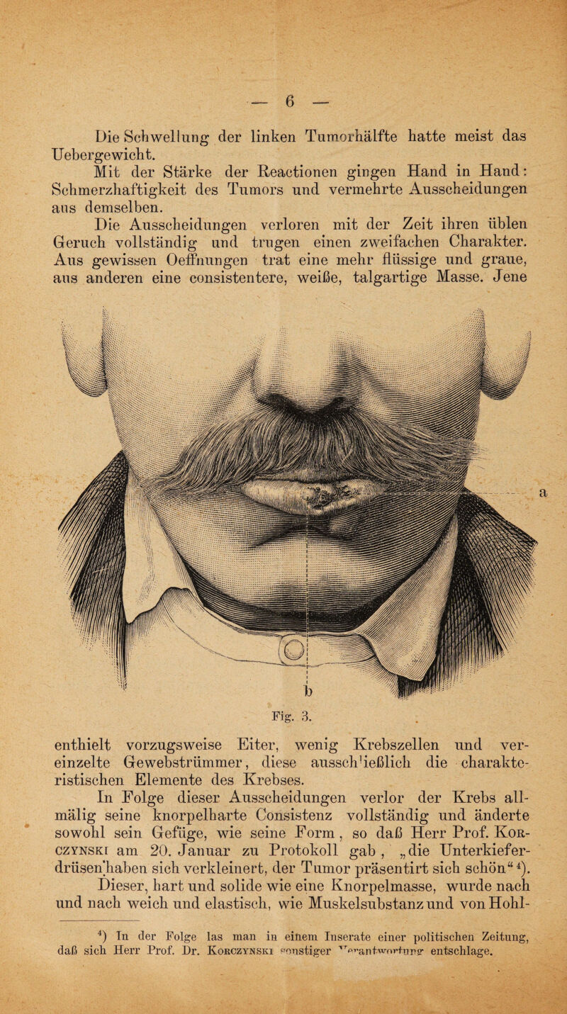 Die Schwellung der linken Tumorhälfte hatte meist das Uebergewiclit. Mit der Stärke der Reaetionen gingen Hand in Hand: Schmerzhaftigkeit des Tumors und vermehrte Ausscheidungen aus demselben. Die Ausscheidungen verloren mit der Zeit ihren üblen Geruch vollständig und trugen einen zweifachen Charakter. Aus gewissen Oeffnungen trat eine mehr flüssige und graue, aus anderen eine consistentere, weiße, talgartige Masse. Jene enthielt vorzugsweise Eiter, wenig Krebszellen und ver¬ einzelte Gewebstrümmer, diese aussch!ießlich die charakte¬ ristischen Elemente des Krebses. In Folge dieser Ausscheidungen verlor der Krebs all- mälig seine knorpelharte Consistenz vollständig und änderte sowohl sein Gefüge, wie seine Form, so daß Herr Prof. Kor- czynski am 20. Januar zu Protokoll gab , „die Unterkiefer¬ drüsenhaben sich verkleinert, der Tumor präsentirt sich schön“4). Dieser, hart und solide wie eine Knorpelmasse, wurde nach und nach weich und elastisch, wie Muskelsubstanz und vonHohl- 4) Tn der Folge las man in einem Inserate einer politischen Zeitung, daß sich Herr Prof. Dr. Korczynski sonstiger TT^ant wo W-ung- entschlage. Fig. 3.