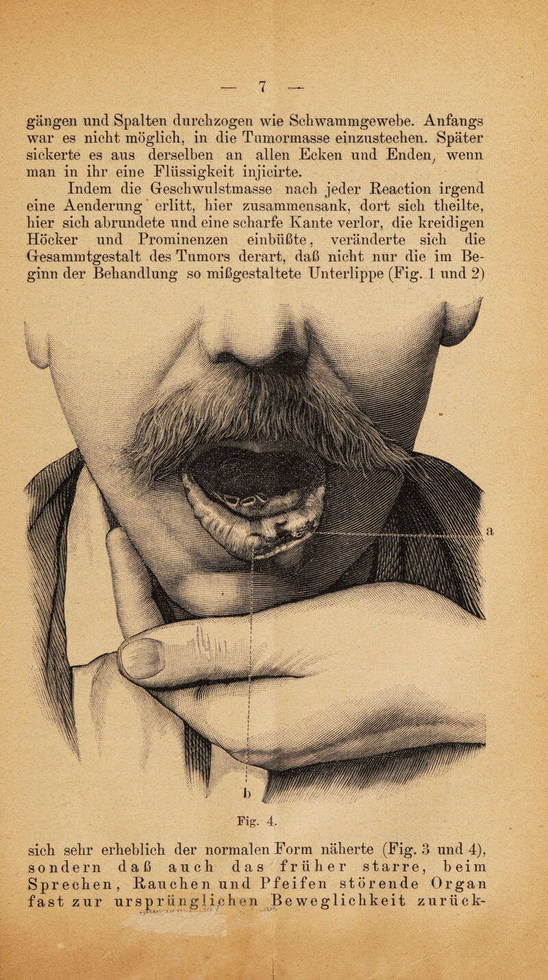 gangen und Spalten durchzogen wie Schwammgewebe. Anfangs war es nicht möglich, in die Tumormasse einzustechen. Später sickerte es aus derselben an allen Ecken und Enden, wenn man in ihr eine Flüssigkeit injicirte. Indem die Gleschwulstmasse nach jeder Reaction irgend eine Aenderung erlitt, hier zusammensank, dort sich theilte, hier sich abrundete und eine scharfe Kante verlor, die kreidigen Höcker und Prominenzen einbüßte, veränderte sich die Giesammtgestalt des Tumors derart, daß nicht nur die im Be¬ ginn der Behandlung so mißgestaltete Unterlippe (Fig. 1 und 2) Fig. 4. sich sehr erheblich der normalen Form näherte (Fig. 3 und 4), sondern daß auch das früher starre, beim Sprechen, Rauchen und Pfeifen störende Organ fast zur ursj)rünglichen Beweglichkeit zurück-