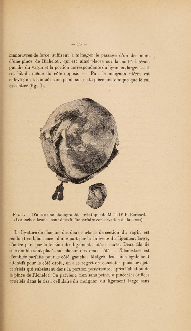 manœuvres de force suffisent à ménager le passage d’un des mors d’une pince de Richelot. qui est ainsi placée sur la moitié latérale gauche du vagin et la portion correspondante du ligament large. — Il est fait de même du côté opposé. — Puis le moignon utérin est enlevé ; on reconnaît sans peine sur cette pièce anatomique que le col est entier (fig. 1). Fig. 1. — D’après une photographie artistique de M. le Dr P. Bernard. (Les taches brunes sont dues à l'imparfaite conservation de la pièce) La ligature de chacune des deux surfaces de section du vagin est rendue très laborieuse, d’une part par la brièveté du ligament large, d’autre part par la tension des ligaments utéro-sacrés. Deux fils de soie double sont placés sur chacun des deux côtés : l’hémostase est d’emblée parfaite pour le côté gauche. Malgré des soins également attentifs pour le côté droit, on a le regret de constater plusieurs jets artériels qui subsistent dans la portion postérieure, après l’ablation de la pince de Richelot. On parvient, non sans peine, à pincer les orifices artériels dans le tissu cellulaire du moignon du ligament large sans