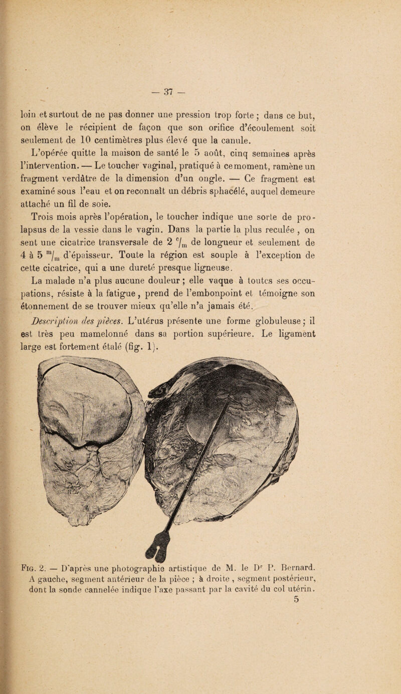 loin et surtout de ne pas donner une pression trop forte ; dans ce but, on élève le récipient de façon que son orifice d’écoulement soit seulement de 10 centimètres plus élevé que la canule. L’opérée quitte la maison de santé le 5 août, cinq semaines après l’intervention. — Le toucher vaginal, pratiqué à ce moment, ramène un fragment verdâtre de la dimension d’un ongle. — Ce fragment est examiné sous l’eau et on reconnaît un débris sphacélé, auquel demeure attaché un fil de soie. Trois mois après l’opération, le toucher indique une sorte de pro¬ lapsus de la vessie dans le vagin. Dans la partie la plus reculée , on sent une cicatrice transversale de 2 c/m de longueur et seulement de 4 à 5 m/m d’épaisseur. Toute la région est souple à l’exception de cette cicatrice, qui a une dureté presque ligneuse. La malade n’a plus aucune douleur ; elle vaque à toutes ses occu¬ pations, résiste à la fatigue, prend de l’embonpoint et témoigne son étonnement de se trouver mieux qu’elle n’a jamais été. Description des pièces. L’utérus présente une forme globuleuse; il est très peu mamelonné dans sa portion supérieure. Le ligament large est fortement étalé (fig. 1). Fig. 2. — D'après une photographie artistique de M. le Dr P. Bernard. A gauche, segment antérieur de la pièce ; à droite , segment postérieur, dont la sonde cannelée indique Taxe passant par la cavité du col utérin. 5