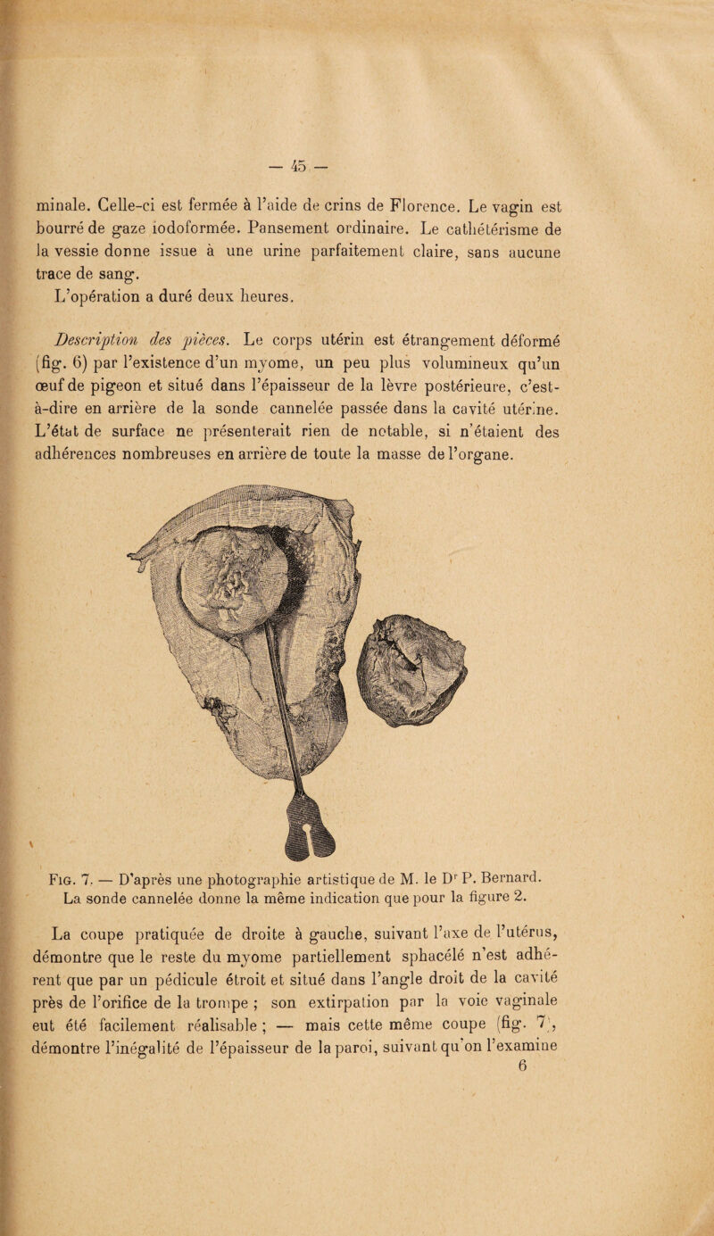 minale. Celle-ci est fermée à l’aide de crins de Florence. Le vagin est bourré de gaze îodoformée. Pansement ordinaire. Le cathétérisme de la vessie donne issue à une urine parfaitement claire, sans aucune trace de sang. L’opération a duré deux heures. Description des pièces. Le corps utérin est étrangement déformé (fig. 6) par l’existence d’un myome, un peu plus volumineux qu’un œuf de pigeon et situé dans l’épaisseur de la lèvre postérieure, c’est- à-dire en arrière de la sonde cannelée passée dans la cavité utérine. L’état de surface ne présenterait rien de notable, si n’étaient des adhérences nombreuses en arrière de toute la masse de l’organe. Fig. 7. — D’après une photographie artistique de M. le Dr P. Bernard. La sonde cannelée donne la même indication que pour la figure 2. La coupe pratiquée de droite à gauche, suivant l’axe de l’utérus, démontre que le reste du myome partiellement sphacélé n’est adhé¬ rent que par un pédicule étroit et situé dans l’angle droit de la cavité près de l’orifice de la trompe ; son extirpation par la voie vaginale eut été facilement réalisable ; — mais cette même coupe (fig. 7’, démontre l’inégalité de l’épaisseur de la paroi, suivant qu on l’examine 6