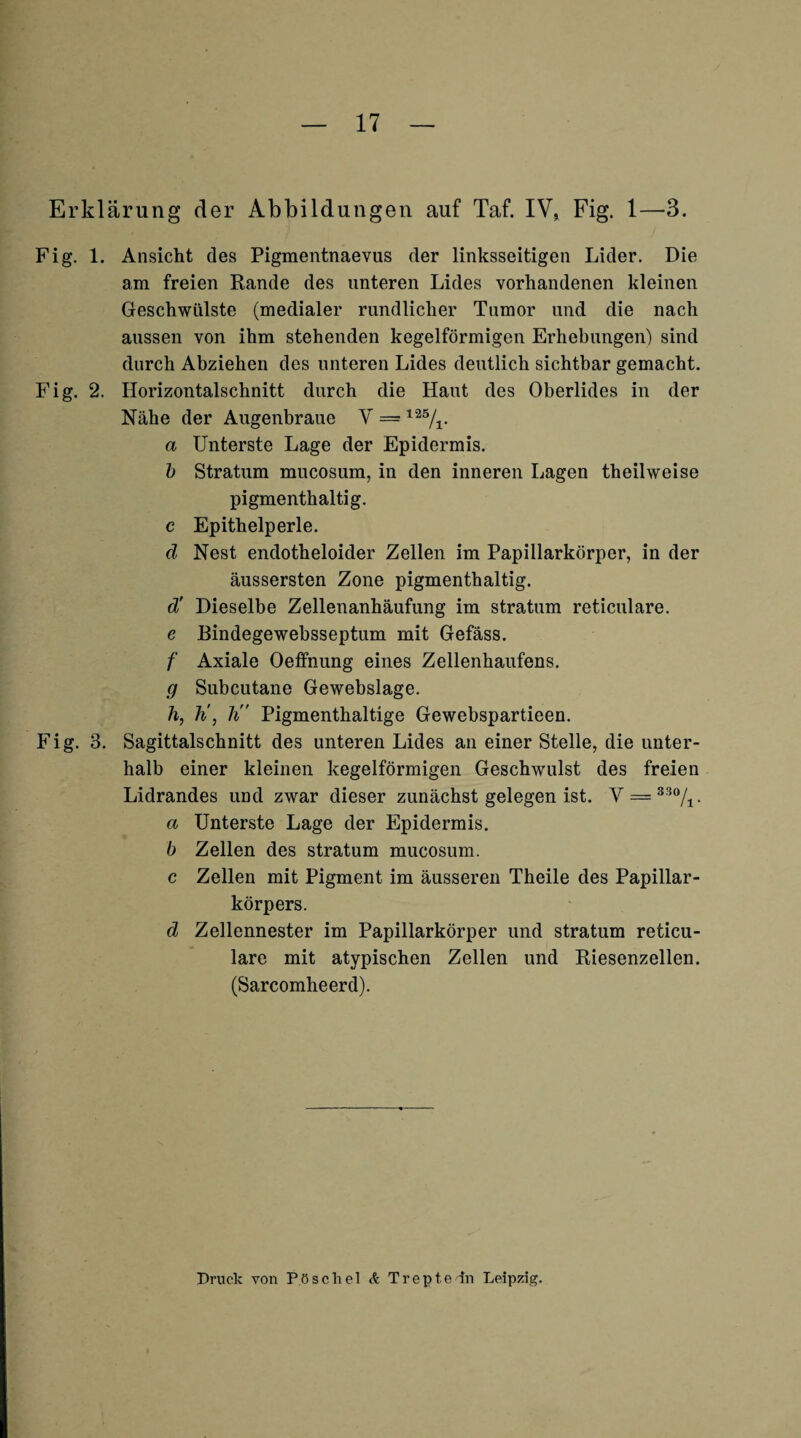 Erklärung der Abbildungen auf Taf. IV, Fig. 1—3. Fig. 1. Ansicht des Pigmentnaevus der linksseitigen Lider. Die am freien Rande des unteren Lides vorhandenen kleinen Geschwülste (medialer rundlicher Tumor und die nach aussen von ihm stehenden kegelförmigen Erhebungen) sind durch Abziehen des unteren Lides deutlich sichtbar gemacht. Fig. 2. Horizontalschnitt durch die Haut des Oberlides in der Nähe der Augenbraue V = a Unterste Lage der Epidermis. h Stratum mucosum, in den inneren Lagen theilweise pigmenthaltig, c Epithelperle. d Nest endotheloider Zellen im Papillarkörper, in der äussersten Zone pigmenthaltig. d' Dieselbe Zellenanhäufung im stratum reticulare. e Bindegewebsseptum mit Gefäss. f Axiale Oeffnung eines Zellenhaufens. g Subcutane Gewebslage. h, h\ h Pigmenthaltige Gewebspartieen. Fig. 3. Sagittalschnitt des unteren Lides an einer Stelle, die unter¬ halb einer kleinen kegelförmigen Geschwulst des freien Lidrandes und zwar dieser zunächst gelegen ist. y = ^^7i- a Unterste Lage der Epidermis. b Zellen des stratum mucosum. c Zellen mit Pigment im äusseren Theile des Papillar¬ körpers. d Zellennester im Papillarkörper und stratum reticu¬ lare mit atypischen Zellen und Riesenzellen. (Sarcomheerd). Druck von Pöschel Treptedn Leipzig.