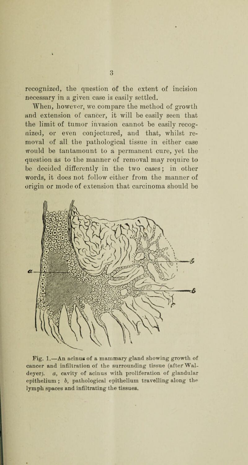 recognized, the question of the extent of incision necessary in a given case is easily settled. When, however, we compare the method of growth and extension of cancer, it will be easily seen that the limit of tumor invasion cannot be easily recog¬ nized, or even conjectured, and that, whilst re¬ moval of all the pathological tissue in either case would be tantamount to a permanent cure, yet the question as to the manner of removal may require to be decided differently in the two cases; in other words, it does not follow either from the manner of origin or mode of extension that carcinoma should be Fig. 1.—An acinus of a mammary gland showing growth of cancer and infiltration of the surrounding tissue (after Wal- deyer;. a, cavity of acinus with proliferation of glandular epithelium ; b, pathological epithelium travelling along the lymph spaces and infiltrating the tissues.