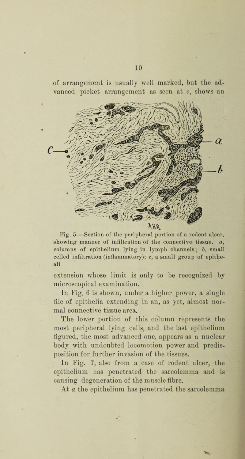 of arrangement is usually well marked, but the ad¬ vanced picket arrangement as seen at c, shows an Fig. 5.—Section of the peripheral portion of a rodent ulcer, showing manner of infiltration of the connective tissue, a, columns of epithelium lying in lymph channels ; b, small celled infiltration (inflammatory); c, a small group of epithe- ali extension whose limit is only to be recognized by microscopical examination. In Fig. 6 is shown, under a higher power, a single file of epithelia extending in an, as yet, almost nor¬ mal connective tissue area. The lower portion of this column represents the most peripheral lying cells, and the last epithelium figured, the most advanced one, appears as a nuclear body with undoubted locomotion power and predis¬ position for further invasion of the tissues. In Fig. 7, also from a case of rodent ulcer, the epithelium lias penetrated the sarcolennna and is causing degeneration of the muscle fibre. At a the epithelium has penetrated the sarcolemma