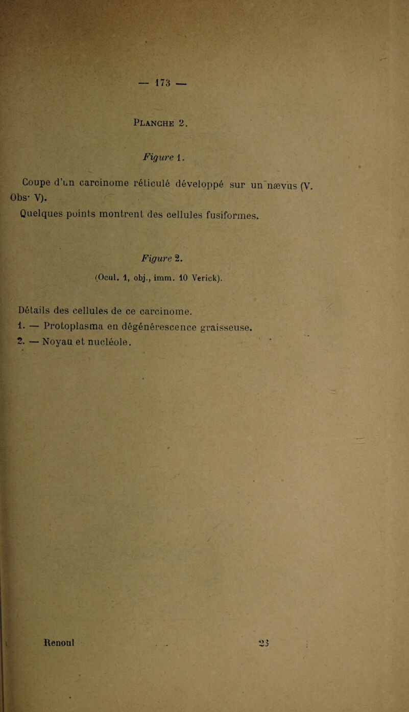 Planche 2. Figure 1. Coupe d’un carcinome réticulé développé sur un naevus (V. Obs* V). Quelques points montrent des cellules fusiformes. Figure 2. (Ocul. 1, obj., imm. 10 Verick). * * / Détails des cellules de ce carcinome. — Protoplasma en dégénérescence graisseuse. 2. — Noyau et nucLéole. Uenoul