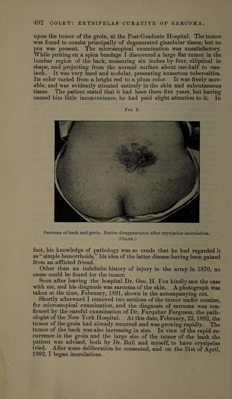 upon the tumor of the groin, at the Post-Graduate Hospital. The tumor was found to consist principally of degenerated glandular tissue, but no pus was present. The microscopical examination was unsatisfactory. While putting on a spica bandage I discovered a large flat tumor in the lumbar region of the back, measuring six inches by four, elliptical in shape, and projecting from the normal surface about one-half to one- inch. It was very hard and nodular, presenting numerous tuberosities. Its color varied from a bright red to a plum color. It was freely mov¬ able, and was evidently situated entirely in the skin and subcutaneous tissue. The patient stated that it had been there five years, but having caused him little inconvenience, he had paid slight attention to it. In Fig. 2. Sarcoma of back and groin. Entire disappearance after erysipelas inoculation. (Coley.) fact, his knowledge of pathology was so crude that he had regarded it as “ simple hemorrhoids,” his idea of the latter disease having been gained from an afflicted friend. Other than an indefinite history of injury in the army in 1870, no cause could be found for the tumor. Soon after leaving the hospital Dr. Geo. H. Fox kindly saw the case with me, and his diagnosis was sarcoma of the skin. A photograph was taken at the time, February, 1891, shown in the accompanying cut. Shortly afterward I removed two sections of the tumor under cocaine, for microscopical examination, and the diagnosis of sarcoma was con¬ firmed by the careful examination of Dr. Farquhar Ferguson, the path¬ ologist of the New York Hospital. At this date, February, 22,1892, the tumor of the groin had already recurred and was growing rapidly. The tumor of the back was also increasing in size. In view of the rapid re¬ currence in the groin and the large size of the tumor of the back the patient was advised, both by Dr. Bull and myself, to have erysipelas tried. After some deliberation he consented, and on the 21st of April, 1892, I began inoculations.