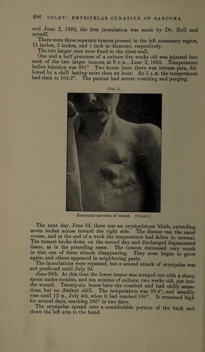 and June 2, 1892, the first inoculation was made by Dr. Bull and myself. There were three separate tumors present in the left mammary region, H inches, 2 inches, and i inch in diameter, respectively. The two larger ones were fixed to the chest-wall. One and a half grammes of a culture five weeks old was injected into each of the two larger tumors, at 9 p.m., June 2, 1892. Temperature before injection was 981° Two hours later there was intense pain, fol¬ lowed by a chill lasting more than an hour. At 3 a.m. the temperature had risen to 104.2°. The patient had severe vomiting and purging. Fig. 3. Recurrent sarcoma of breast. (Colky.) The next day, June 3d, there was an erysipelatous blush, extending seven inches across toward the right side. The disease ran the usual course, and at the end of a week the temperature had fallen to normal. The tumors broke down on the second day and discharged degenerated tissue, as in the preceding cases. The tumors decreased very much in size, one of them almost disappearing. They soon began to grow again, and others appeared in neighboring parts. The inoculations were repeated, but a second attack of erysipelas was not produced until July 2d. June 30th. At this time the lower tumor was scraped out with a sharp spoon under cocaine, and ten minims of culture, two weeks old, put into the wound. Twenty-six hours later she vomited and had chilly sensa¬ tions, but no distinct chill. The temperature was 99.4°, and steadily rose until 12 m., July 4th, when it had reached 104°. It remained high for several days, reaching 105° in two days. The erysipelas spread over a considerable portion of the back and down the left arm to the hand.