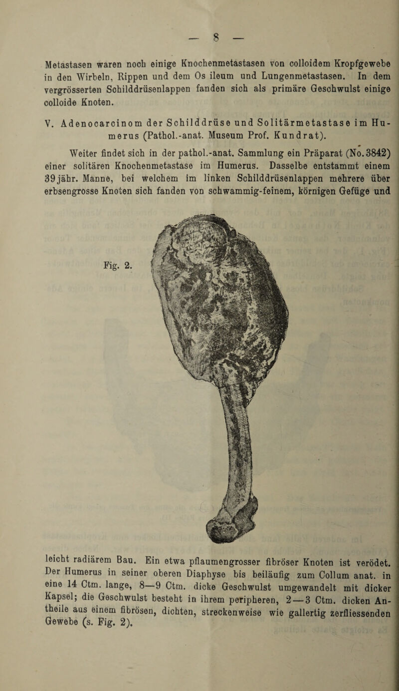 Metastasen waren noch einige Knochenmetastasen von colloidem Kropfgewebe in den Wirbeln, Rippen und dem Os ileum und Lungenmetastasen. In dem vergrösserten Sohilddrüsenlappen fanden sich als primäre Geschwulst einige colloide Knoten. V. Adenocarcinom der Schilddrüse und Solitärmetastase im Hu¬ merus (Pathol.-anat. Museum Prof. Kundrat). m Weiter findet sich in der pathol.-anat. Sammlung ein Präparat (No. 3842) einer solitären Knochenmetastase im Humerus. Dasselbe entstammt einem 39jähr. Manne, bei welchem im linken Schilddrüsenlappen mehrere über erbsengrosse Knoten sich fanden von schwammig-feinem, körnigen Gefüge und Fig. 2. leicht radiärem Bau. Ein etwa pflaumengrosser fibröser Knoten ist verödet. Der Humerus in seiner oberen Diaphyse bis beiläufig zum Collum anat. in eine 14 Ctm. lange, 8—9 Ctm. dicke Geschwulst umgewandelt mit dicker Kapsel; die Geschwulst besteht in ihrem peripheren, 2 — 3 Ctm. dicken An- theile aus einem fibrösen, dichten, streckenweise wie gallertig zerfliessenden Gewebe (s. Fig. 2).