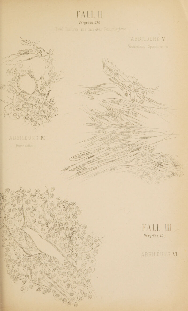 Vorwiegen d Spindelzejlen FAIl II. Vergröss. 420 L'.yei 'A; me rer» au 3 derselben Femur diaphyse FALL III. Vergross. 420 ABBILDUNG VI.