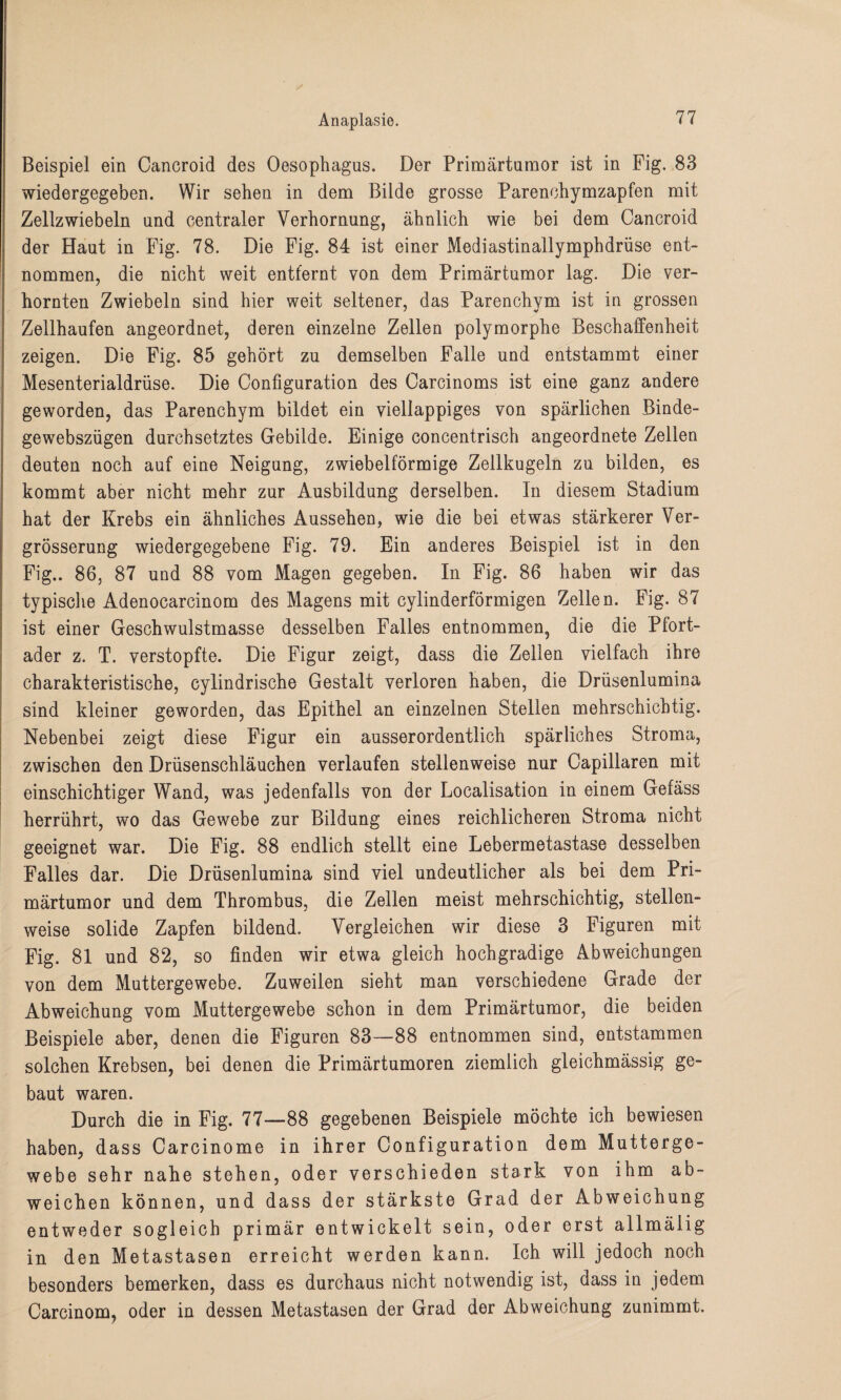 Beispiel ein Cancroid des Oesophagus. Der Primärtumor ist in Fig. 83 wiedergegeben. Wir sehen in dem Bilde grosse Parenchymzapfen mit Zellzwiebeln und centraler Verhornung, ähnlich wie bei dem Cancroid der Haut in Fig. 78. Die Fig. 84 ist einer Mediastinallymphdrüse ent¬ nommen, die nicht weit entfernt von dem Primärtumor lag. Die ver¬ hornten Zwiebeln sind hier weit seltener, das Parenchym ist in grossen Zellhaufen angeordnet, deren einzelne Zellen polymorphe Beschaffenheit zeigen. Die Fig. 85 gehört zu demselben Falle und entstammt einer Mesenterialdrüse. Die Configuration des Carcinoms ist eine ganz andere geworden, das Parenchym bildet ein viellappiges von spärlichen Binde- gewebszügen durchsetztes Gebilde. Einige concentrisch angeordnete Zellen deuten noch auf eine Neigung, zwiebelförmige Zellkugeln zu bilden, es kommt aber nicht mehr zur Ausbildung derselben. In diesem Stadium hat der Krebs ein ähnliches Aussehen, wie die bei etwas stärkerer Ver- grösserung wiedergegebene Fig. 79. Ein anderes Beispiel ist in den Fig.. 86, 87 und 88 vom Magen gegeben. In Fig. 86 haben wir das typische Adenocarcinom des Magens mit cylinderförmigen Zellen. Fig. 87 ist einer Geschwulstmasse desselben Falles entnommen, die die Pfort¬ ader z. T. verstopfte. Die Figur zeigt, dass die Zellen vielfach ihre charakteristische, cylindrische Gestalt verloren haben, die Drüsenlumina sind kleiner geworden, das Epithel an einzelnen Stellen mehrschichtig. Nebenbei zeigt diese Figur ein ausserordentlich spärliches Stroma, zwischen den Drüsenschläuchen verlaufen stellenweise nur Capillaren mit einschichtiger Wand, was jedenfalls von der Localisation in einem Gefäss herrührt, wo das Gewebe zur Bildung eines reichlicheren Stroma nicht geeignet war. Die Fig. 88 endlich stellt eine Lebermetastase desselben Falles dar. Die Drüsenlumina sind viel undeutlicher als bei dem Pri¬ märtumor und dem Thrombus, die Zellen meist mehrschichtig, stellen¬ weise solide Zapfen bildend. Vergleichen wir diese 3 Figuren mit Fig. 81 und 82, so finden wir etwa gleich hochgradige Abweichungen von dem Muttergewebe. Zuweilen sieht man verschiedene Grade der Abweichung vom Muttergewebe schon in dem Primärtumor, die beiden Beispiele aber, denen die Figuren 83—88 entnommen sind, entstammen solchen Krebsen, bei denen die Primärtumoren ziemlich gleichmässig ge¬ baut waren. Durch die in Fig. 77—88 gegebenen Beispiele möchte ich bewiesen haben, dass Carcinome in ihrer Configuration dem Mutterge¬ webe sehr nahe stehen, oder verschieden stark von ihm ab¬ weichen können, und dass der stärkste Grad der Abweichung entweder sogleich primär entwickelt sein, oder erst allmälig in den Metastasen erreicht werden kann. Ich will jedoch noch besonders bemerken, dass es durchaus nicht notwendig ist, dass in jedem Carcinom, oder in dessen Metastasen der Grad der Abweichung zunimmt.