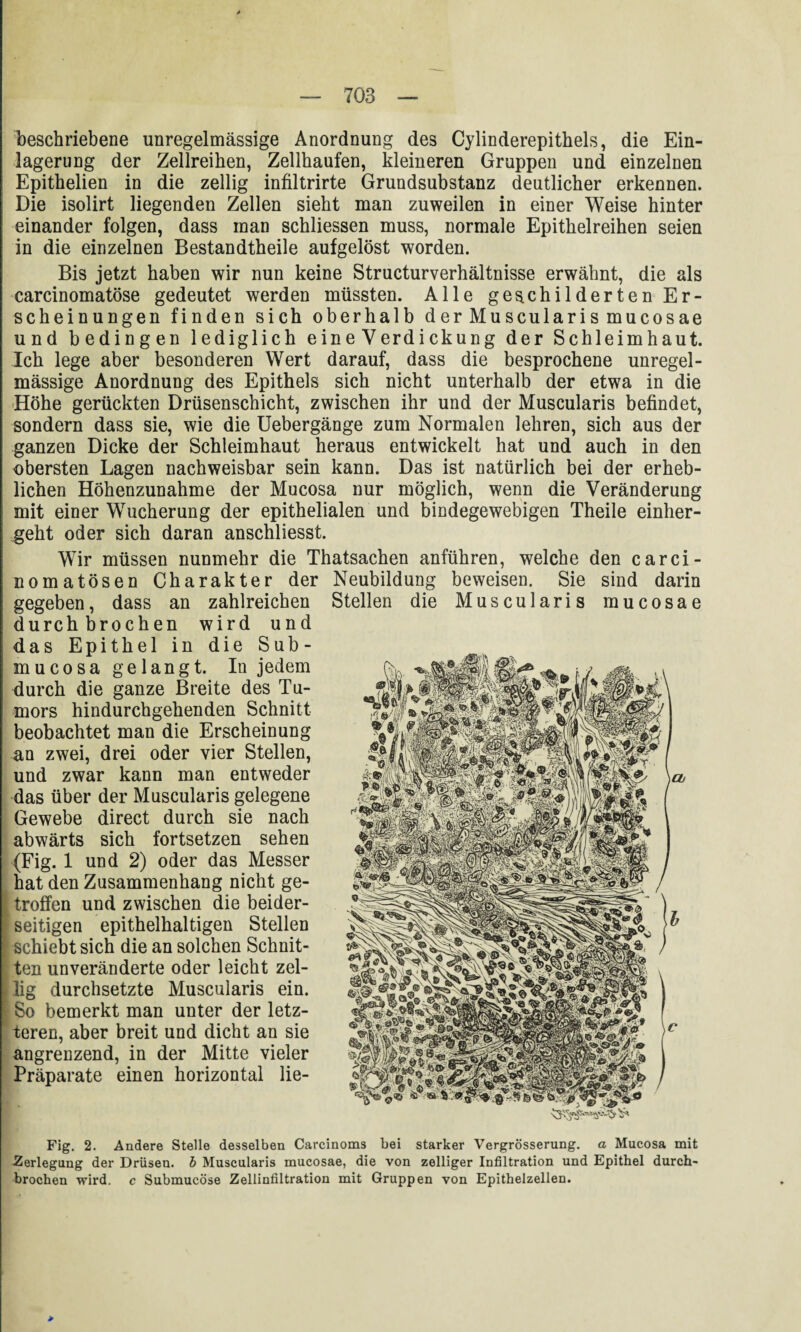 beschriebene unregelmässige Anordnung des Cylinderepithels, die Ein¬ lagerung der Zellreihen, Zellhaufen, kleineren Gruppen und einzelnen Epithelien in die zellig infiltrirte Grundsubstanz deutlicher erkennen. Die isolirt liegenden Zellen sieht man zuweilen in einer Weise hinter einander folgen, dass man schliessen muss, normale Epithelreihen seien in die einzelnen Bestandtheile aufgelöst worden. Bis jetzt haben wir nun keine Structurverhältnisse erwähnt, die als carcinomatöse gedeutet werden müssten. Alle geschilderten Er¬ scheinungen finden sich oberhalb der Muscularis mucosae und bedingen lediglich eine Verdickung der Schleimhaut. Ich lege aber besonderen Wert darauf, dass die besprochene unregel¬ mässige Anordnung des Epithels sich nicht unterhalb der etwa in die 'Höhe gerückten Drüsenschicht, zwischen ihr und der Muscularis befindet, sondern dass sie, wie die Uebergänge zum Normalen lehren, sich aus der ganzen Dicke der Schleimhaut heraus entwickelt hat und auch in den obersten Lagen nachweisbar sein kann. Das ist natürlich bei der erheb¬ lichen Höhenzunahme der Mucosa nur möglich, wenn die Veränderung mit einer Wucherung der epithelialen und bindegewebigen Theile einher¬ geht oder sich daran anschliesst. Wir müssen nunmehr die Thatsachen anführen, welche den carci- nomatösen Charakter der Neubildung beweisen. Sie sind darin gegeben, dass an zahlreichen durchbrochen wird und das Epithel in die Sub- mucosa gelangt. In jedem durch die ganze Breite des Tu¬ mors hindurchgehenden Schnitt beobachtet man die Erscheinung an zwei, drei oder vier Stellen, und zwar kann man entweder das über der Muscularis gelegene Gewebe direct durch sie nach abwärts sich fortsetzen sehen (Fig. 1 und 2) oder das Messer hat den Zusammenhang nicht ge- I troffen und zwischen die beider- f seitigen epithelhaltigen Stellen I schiebt sich die an solchen Schnit- [ ten unveränderte oder leicht zel- |lig durchsetzte Muscularis ein. l So bemerkt man unter der letz¬ teren, aber breit und dicht an sie angrenzend, in der Mitte vieler Präparate einen horizontal lie- Fig. 2. Andere Stelle desselben Carcinoms bei starker Vergrösserung. a Mucosa mit •Zerlegung der Drüsen, h Muscularis mucosae, die von zelliger Infiltration und Epithel durch¬ brochen wird, c Submucöse Zellinfiltration mit Gruppen von Epithelzellen. Stellen die Muscularis mucosae > * >