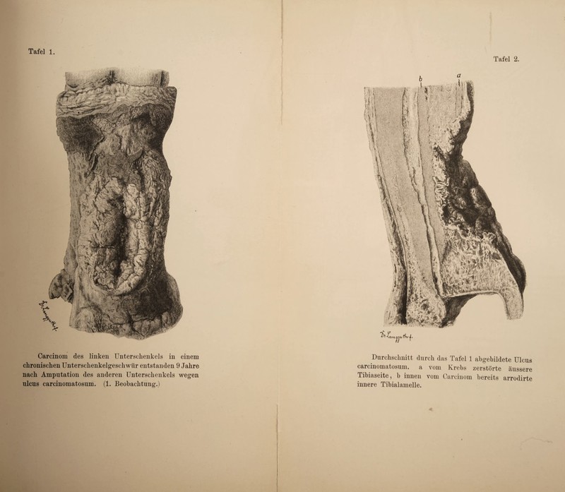 Tafel 1. Carcinom des linken Unterschenkels in einem chronischen Unterschenkelgeschwür entstanden 9 Jahre nach Amputation des anderen Unterschenkels wegen ulcus carcinomatosum. (1. Beobachtung.) j Tafel 2. Durchschnitt durch das Tafel 1 abgehildete Ulcus carcinomatosum. a vom Krebs zerstörte äussere Tibiaseite, b innen vom Carcinom bereits arrodirte innere Tibialamelle.
