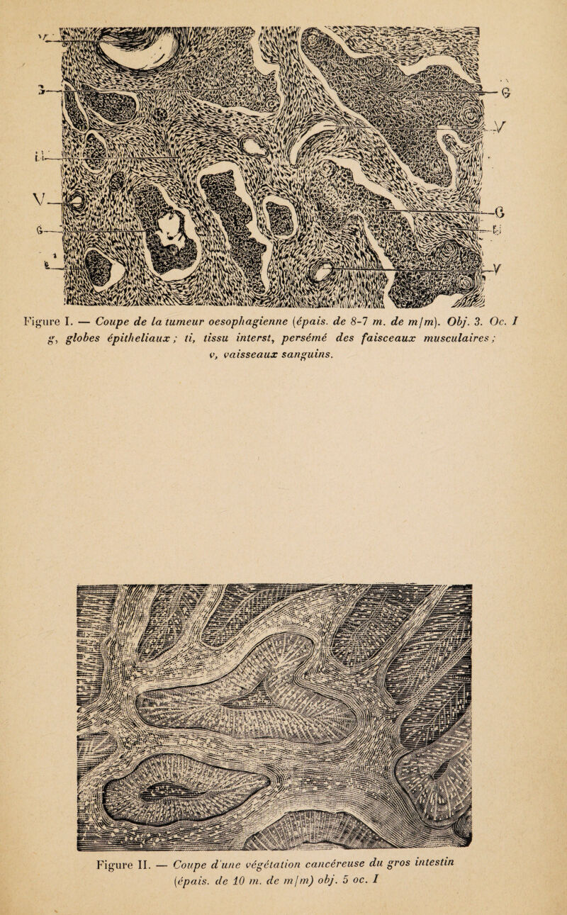 igure I. — Coupe de la tumeur oesophagienne [épais, de 8-7 m. de mfm). Obj. 3. Oc. I g, globes épitheliaux ; ti, tissu interst, persémé des faisceaux musculaires ; v, vaisseaux sanguins. Figure IL — Coupe d'une végétation cancéreuse du gros intestin [épais, de 10 m. de mjm) obj. 5 oc. I