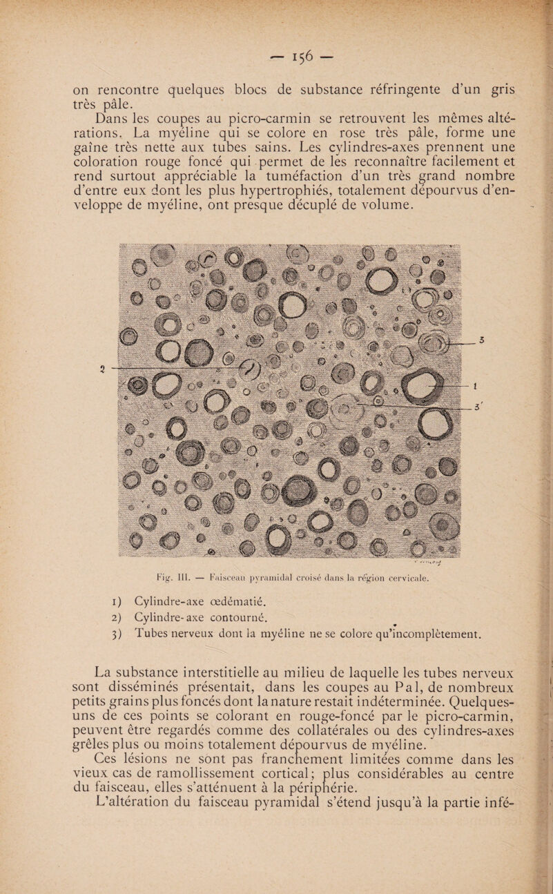 on rencontre quelques blocs de substance réfringente d’un gris très pâle. Dans les coupes au picro-carmin se retrouvent les mêmes alté¬ rations. La myéline qui se colore en rose très pâle, forme une gaine très nette aux tubes sains. Les cylindres-axes prennent une coloration rouge foncé qui permet de les reconnaître facilement et rend surtout appréciable la tuméfaction d’un très grand nombre d’entre eux dont les plus hypertrophiés, totalement dépourvus d’en¬ veloppe de myéline, ont presque décuplé de volume. Fig. III. — Faisceau pyramidal croisé dans la région cervicale. 1) Cylindre-axe œdématié. 2) Cylindre-axe contourné. 3) Tubes nerveux dont la myéline ne se colore qu’incomplètement. La substance interstitielle au milieu de laquelle les tubes nerveux sont disséminés présentait, dans les coupes au Pal, de nombreux petits grains plus foncés dont la nature restait indéterminée. Quelques- uns de ces points se colorant en rouge-foncé par le picro-carmin, peuvent être regardés comme des collatérales ou des cylindres-axes grêles plus ou moins totalement dépourvus de myéline. Ces lésions ne sont pas franchement limitées comme dans les vieux cas de ramollissement cortical ; plus considérables au centre du faisceau, elles s’atténuent à la périphérie. L’altération du faisceau pyramidal s’étend jusqu’à la partie infé-