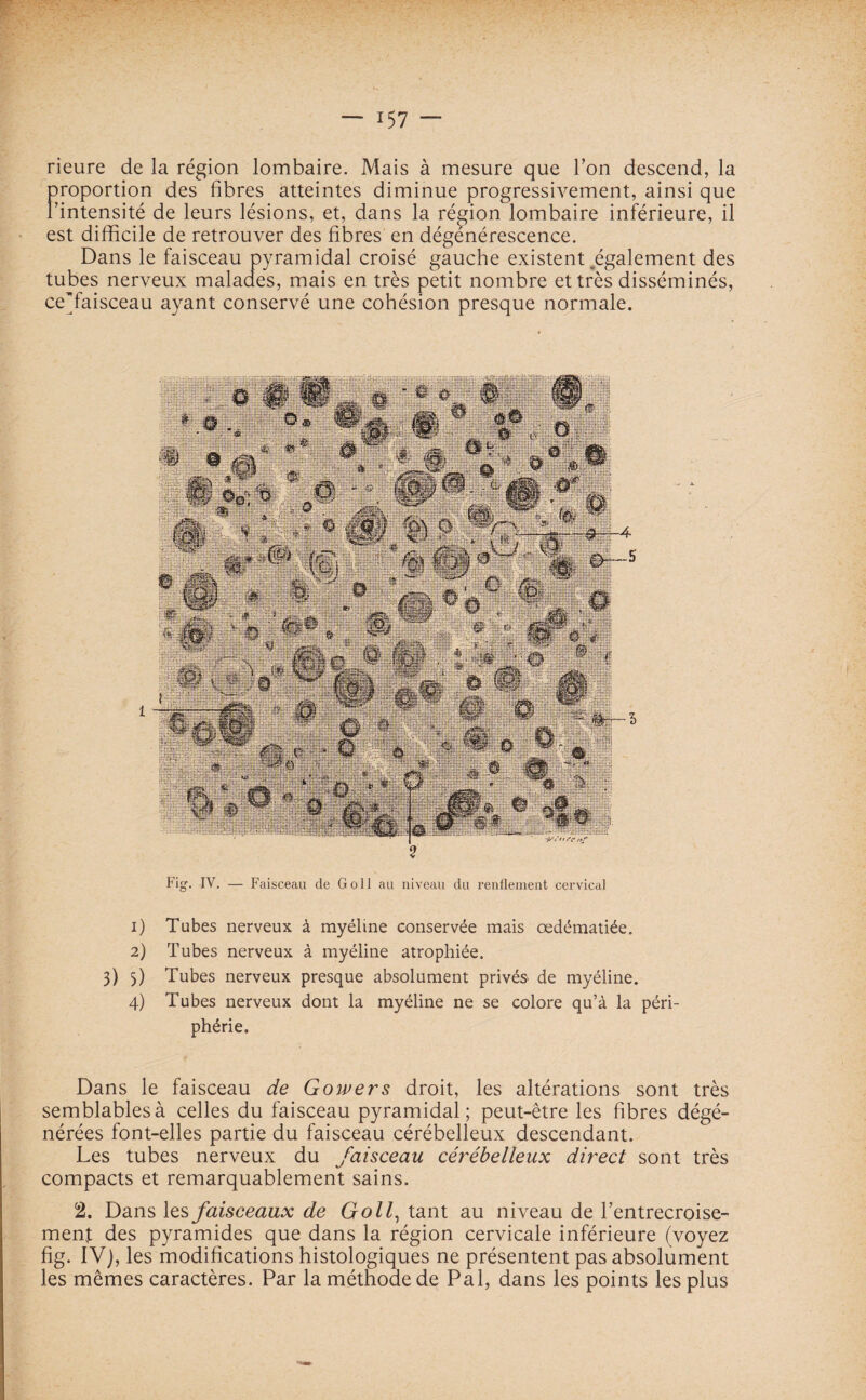 x57 rieure de la région lombaire. Mais à mesure que l’on descend, la proportion des fibres atteintes diminue progressivement, ainsi que l’intensité de leurs lésions, et, dans la région lombaire inférieure, il est difficile de retrouver des fibres en dégénérescence. Dans le faisceau pyramidal croisé gauche existent ^également des tubes nerveux malades, mais en très petit nombre et très disséminés, ceVaisceau ayant conservé une cohésion presque normale. Fig. IV. — Faisceau de Goll au niveau du renflement cervical 1) Tubes nerveux à myéline conservée mais œdématiée. 2) Tubes nerveux à myéline atrophiée. 3) 3) Tubes nerveux presque absolument privés de myéline. 4) Tubes nerveux dont la myéline ne se colore qu’à la péri¬ phérie. Dans le faisceau de Gowers droit, les altérations sont très semblables à celles du faisceau pyramidal; peut-être les fibres dégé¬ nérées font-elles partie du faisceau cérébelleux descendant. Les tubes nerveux du faisceau cérébelleux direct sont très compacts et remarquablement sains. 2. Dans les faisceaux de Goll, tant au niveau de l’entrecroise¬ ment des pyramides que dans la région cervicale inférieure (voyez fig. IV), les modifications histologiques ne présentent pas absolument les mêmes caractères. Par la méthode de Pal, dans les points les plus