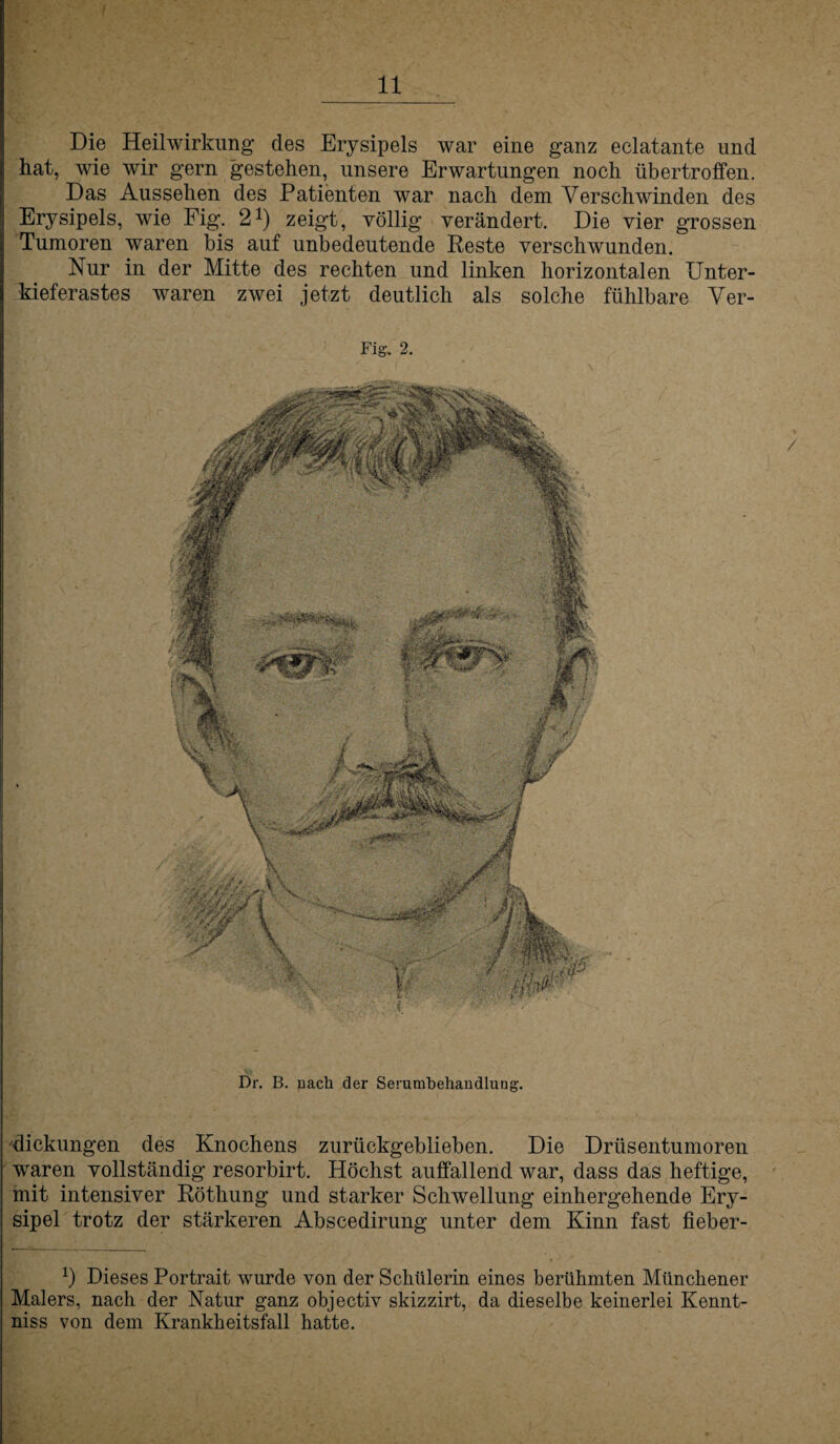 Die Heilwirkung des Erysipels war eine ganz eclatante und hat, wie wir gern gestehen, unsere Erwartungen noch übertroffen. Das Aussehen des Patienten war nach dem Verschwinden des Erysipels, wie Fig. 21) zeigt, völlig verändert. Die vier grossen Tumoren waren bis auf unbedeutende Reste verschwunden. Nur in der Mitte des rechten und linken horizontalen Unter¬ kieferastes waren zwei jetzt deutlich als solche fühlbare Ver- Fig. 2. A Dr. B. nach der Serumbehandluug. dickungen des Knochens zurückgeblieben. Die Drüsentumoren waren vollständig resorbirt. Höchst auffallend war, dass das heftige, mit intensiver Röthung und starker Schwellung einhergehende Ery¬ sipel trotz der stärkeren Abscedirung unter dem Kinn fast fieber- *) Dieses Portrait wurde von der Schülerin eines berühmten Münchener Malers, nach der Natur ganz objectiv skizzirt, da dieselbe keinerlei Kennt- niss von dem Krankheitsfall hatte.