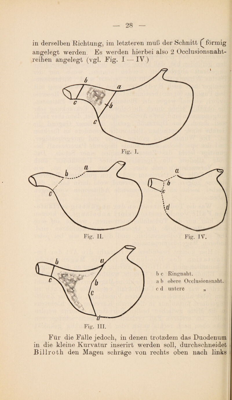 in derselben Richtung, irn letzteren muß der Schnitt förmig angelegt werden. Es werden hierbei also 2 Occlusionsnaht- reihen angelegt (vgl. Fig. I — IV.) Fig. III. b c Kingnaht, a b obere Occlusionsnaht, c d untere „ Für die Fälle jedoch, in denen trotzdem das Duodenum in die kleine Kurvatur inserirt werden soll, durchschneidet Billroth den Magen schräge von rechts oben nach links