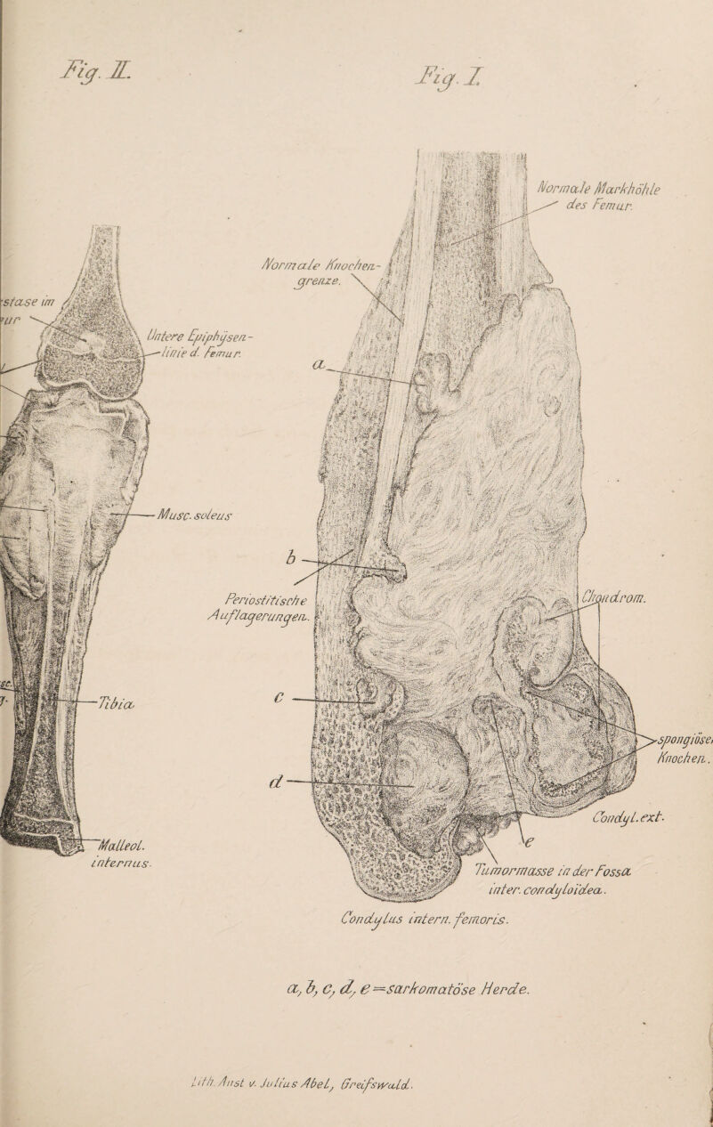 • i m sMifSH vidrom. ■spongiose* Knochen. Normale markhöhle  des Femur. ■stase im wr Tibia■ rek. /Vor/nahe Fr/oeben.- J ' J grenze. v ' ^ Untere Epiphysen - iim e d. Femur. Muse- soieu^ internus. Perwst/tische [ 4em,.rr. r Auflagerungen. ^ . -WH1 p imÖ ?iXts&O ■ '£ ■ eeYV.${<MKKh. Ccm dpi- ext Tu.mormasse in der Fossa inter. condgloidea. Condplus intern, femoris. OL, C/ dy 6 —sarkomatöse Herde. Li Ni. Aust i/. Julius Abel, GreifswecUoL- ■