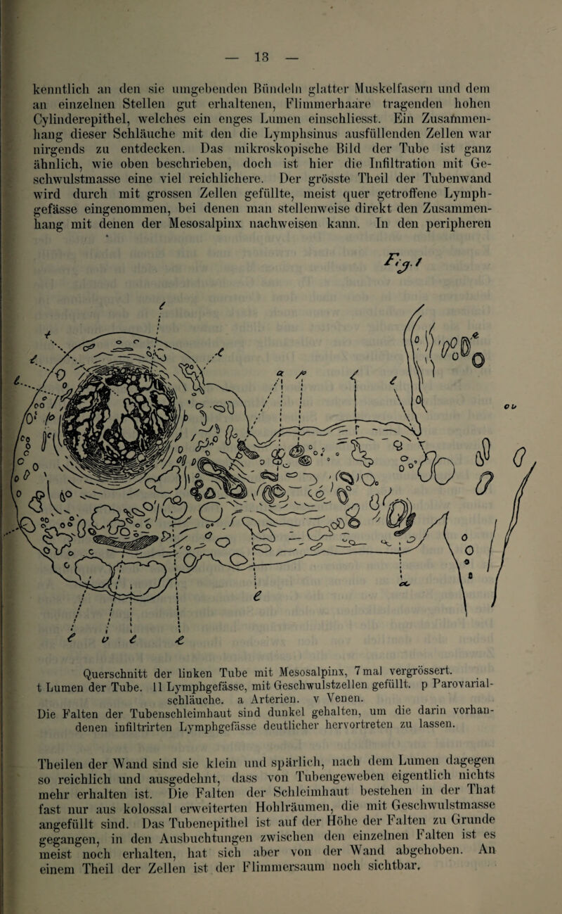 ©0C kenntlich an den sie umgebenden Bündeln glatter Muskelfasern und dem an einzelnen Stellen gut erhaltenen, Flimmerhaäre tragenden hohen Cylinderepithel, welches ein enges Lumen einschliesst. Ein Zusammen¬ hang dieser Schläuche mit den die Lymphsinus ausfüllenden Zellen war nirgends zu entdecken. Das mikroskopische Bild der Tube ist ganz ähnlich, wie oben beschrieben, doch ist hier die Infiltration mit Ge¬ schwulstmasse eine viel reichlichere. Der grösste Theil der Tubenwand wird durch mit grossen Zellen gefüllte, meist quer getroffene Lymph- gefässe eingenommen, bei denen man stellenweise direkt den Zusammen¬ hang mit denen der Mesosalpinx nachweiseil kann. In den peripheren • F,j./ Querschnitt der linken Tube mit Mesosalpinx, 7 mal vergrössert. t Lumen der Tube. 11 Lymphgefässe, mit Geschwulstzellen gefüllt, p Parovarial- schläuche. a Arterien, v Venen. Die Falten der Tubenschleimhaut sind dunkel gehalten, um die darin vorhan¬ denen infiltrirten Lymphgefässe deutlicher hervortreten zu lassen. Th eilen der Wand sind sie klein und spärlich, nach dem Lumen dagegen so reichlich und ausgedehnt, dass von Tubengeweben eigentlich nichts mehr erhalten ist. Die Falten der Schleimhaut bestehen in der lliat fast nur aus kolossal erweiterten Hohlräumen, die mit Geschwulstmasse angefüllt sind. Das Tubenepithel ist auf der Höhe der Falten zu Grunde gegangen, in den Ausbuchtungen zwischen den einzelnen halten ist es meist noch erhalten, hat sich aber von der Wand abgehoben. An einem Theil der Zellen ist der Flimmersaum noch sichtbar.