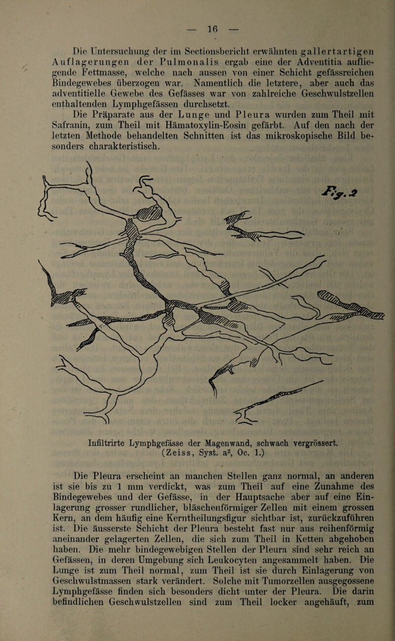 Die Untersuchung der im Sectionsbericht erwähnten gallertartigen Auflagerungen der Pulmonalis ergab eine der Adventitia auflie¬ gende Fettmasse, welche nach aussen von einer Schicht gefässreichen Bindegewebes überzogen war. Namentlich die letztere, aber auch das adventitielle Gewebe des Gefässes war von zahlreiche Geschwulstzellen enthaltenden Lymphgefässen durchsetzt. Die Präparate aus der Lunge und Pleura wurden zum Theil mit Safranin, zum Theil mit Hämatoxylin-Eosin gefärbt. Auf den nach der letzten Methode behandelten Schnitten ist das mikroskopische Bild be¬ sonders charakteristisch. Infiltrirte Lymphgefässe der Magenwand, schwach vergrössert. (Zeiss, Syst, a2, Oc. 1.) Die Pleura erscheint an manchen Stellen ganz normal, an anderen ist sie bis zu 1 mm verdickt, was zum Theil auf eine Zunahme des Bindegewebes und der Gefässe, in der Hauptsache aber auf eine Ein¬ lagerung grosser rundlicher, bläschenförmiger Zellen mit einem grossen Kern, an dem häufig eine Kerntheilungsfigur sichtbar ist, zurückzuführen ist. Die äusserste Schicht der Pleura besteht fast nur aus reihenförmig aneinander gelagerten Zellen, die sich zum Theil in Ketten abgehoben haben. Die mehr bindegewebigen Stellen der Pleura sind sehr reich an Gelassen, in deren Umgebung sich Leukocyten angesammelt haben. Die Lunge ist zum Theil normal, zum Theil ist sie durch Einlagerung von Geschwulstmassen stark verändert. Solche mit Tumorzellen ausgegossene Lymphgefässe linden sich besonders dicht unter der Pleura. Die darin befindlichen Geschwulstzellen sind zum Theil locker angehäuft, zum