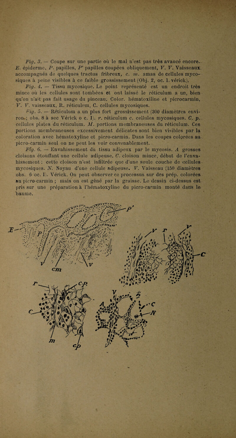 Fig. 3. — Coupe sur une partie où le mal n’est pas très avancé encore. E. épiderme, P. papilles, P’ papilles coupées obliquement, V. V. Vaisseaux,: accompagnés de quelques tractas fribreux, c. m. amas de cellules myco¬ siques à peine visibles à ce faible grossissement (Obj. 2, oc. 1. vérick). Fig. 4. — Tissu mycosique. Le point représenté est un endroit très mince où les cellules sont tombées et ont laissé le réticulum a un, bien qu’on n’ait pas fait usage du pinceau. Color. hématoxiline et picrocarmin, V. V. vaisseaux, R. réticulum, C. cellules mycosiques. Fig. o. — Réticulum a un plus fort grossissement (300 diamètres envi- rom; obs. 8 à sec Vérick o c. I). r. réticulum c. cellules mycosiques. C. p. cellules plates du réticulum. M. portions membraneuses du réticulum. Ces portions membraneuses excessivement délicates sont bien visibles par la coloration avec hématoxyline et picro-carmin. Dans les coupes colorées au picro-carmin seul on ne peut les voir convenablement. Fig. 6. — Envahissement du tissu adipeux par le mycosis. A grosses cloisons étouffant une cellule ailipeuse. C. cloison mince, début de l’enva¬ hissement ; cette cloison n’est infiltrée que d’une seule couche de cellules mycosiques. N. Noyau d’une cellule adipeuse. V. Vaisseau (150 diamètres obs. 6 oc. I). Vérick. On peut observer ce processus sur des prép. colorées au picro-carmin ; mais on est gêné par la graisse. Le dessin ci-dessus est pris sur une préparation à l’héraatoxyline du picro-carmin monté dans le- Laume.