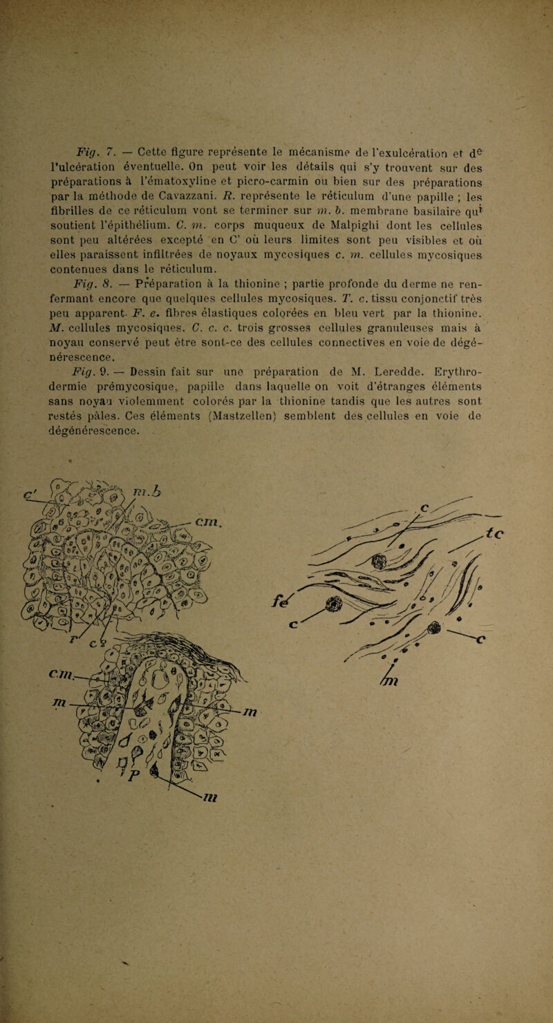 r Fig. 7. — Cette figure représente le mécanisme de l'exulcération et de l’ulcération éventuelle. On peut voir les détails qui s’y trouvent sur des préparations à l’ématoxyline et picro-carmin ou bien sur des préparations par la méthode de Cavazzani. R. représente le réticulum d’une papille ; les fibrilles de ce réticulum vont se terminer sur m. b. membrane basilaire qu* soutient l’épithélium. C. m. corps muqueux de Malpiglii dont les cellules sont peu altérées excepté en C’ où leurs limites sont peu visibles et où elles paraissent infiltrées de noyaux mycosiques c. m. cellules mycosiques contenues dans le réticulum. Fig. 8. — Préparation à la thionine ; partie profonde du derme ne ren¬ fermant encore que quelques cellules mycosiques. T. c. tissu conjonctif très peu apparent- F. e. fibres élastiques colorées en bleu vert par la thionine. M. cellules mycosiques. C. c. c. trois grosses cellules granuleuses mais à noyau conservé peut être sont-ce des cellules connectives en voie de dégé¬ nérescence. Fig. 9. — Dessin fait sur une préparation de M. Leredde. Erythro¬ dermie prémycosique, papille dans laquelle on voit d’étranges éléments sans noyau violemment colorés par la thionine tandis que les autres sont restés pâles. Ces éléments (Mastzellen) semblent des cellules en voie de dégénérescence. te