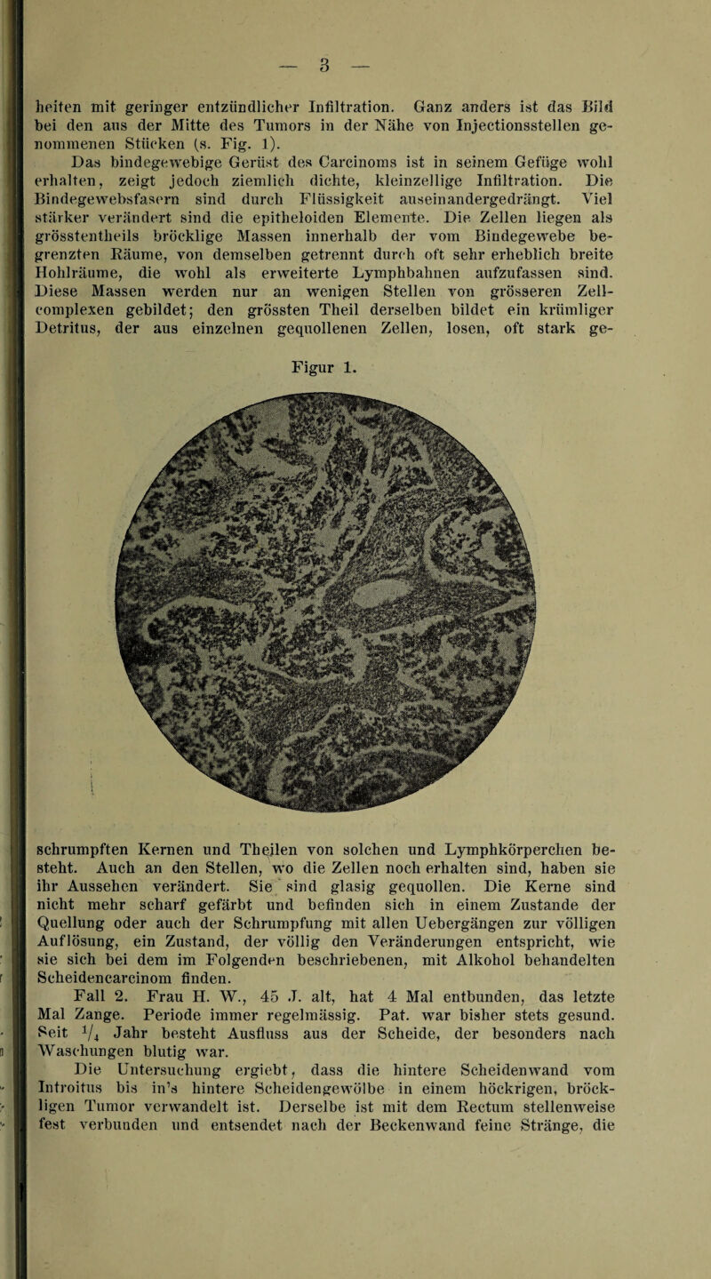 heiten mit geringer entzündlicher Infiltration. Ganz anders ist das Bild hei den aus der Mitte des Tumors in der Nähe von Injectionsstellen ge¬ nommenen Stänken (s. Fig. 1). Das bindegewebige Gerüst des Carcinoms ist in seinem Gefüge wohl erhalten, zeigt jedoch ziemlich dichte, kleinzellige Infiltration. Die Bindegewebsfasern sind durch Flüssigkeit auseinandergedrängt. Viel stärker verändert sind die epitheloiden Elemente. Die Zellen liegen als grösstentlieils bröcklige Massen innerhalb der vom Bindegewebe be¬ grenzten Räume, von demselben getrennt durch oft sehr erheblich breite Hohlräume, die wrohl als erweiterte Lymphbahnen aufzufassen sind. Diese Massen werden nur an wenigen Stellen von grösseren Zell- eomplexen gebildet; den grössten Theil derselben bildet ein krümliger Detritus, der aus einzelnen gequollenen Zellen, losen, oft stark ge- Figur 1. schrumpften Kernen und Theilen von solchen und Lymphkörperclien be¬ steht. Auch an den Stellen, wo die Zellen noch erhalten sind, haben sie ihr Aussehen verändert. Sie sind glasig gequollen. Die Kerne sind nicht mehr scharf gefärbt und befinden sich in einem Zustande der Quellung oder auch der Schrumpfung mit allen Uebergängen zur völligen Auflösung, ein Zustand, der völlig den Veränderungen entspricht, wie sie sich bei dem im Folgenden beschriebenen, mit Alkohol behandelten Scheidencarcinom finden. Fall 2. Frau H. W., 45 J. alt, hat 4 Mal entbunden, das letzte Mal Zange. Periode immer regelmässig. Pat. war bisher stets gesund. Seit 1/4 Jahr besteht Ausfluss aus der Scheide, der besonders nach Waschungen blutig war. Die Untersuchung ergiebt, dass die hintere Scheidenwand vom Introitus bis in’s hintere Scheidengewölbe in einem höckrigen, bröck¬ ligen Tumor verwandelt ist. Derselbe ist mit dem Rectum stellenweise fest verbunden und entsendet nach der Beckenwand feine Stränge, die