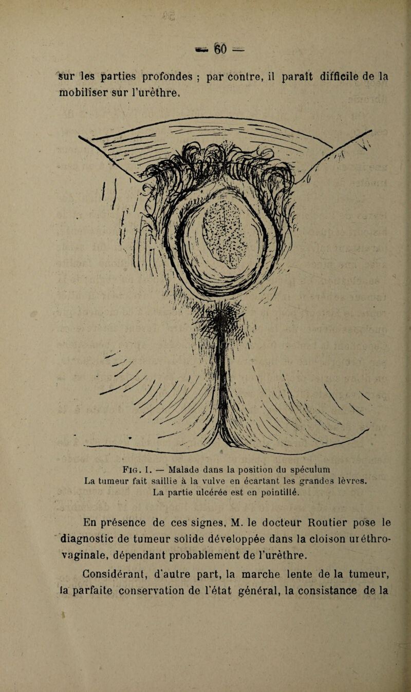 sur les parties profondes ; par contre, il paraît difficile de la mobiliser sur l’urèthre. Fig. I. — Malade dans la position du spéculum La tumeur fait saillie à la vulve en écartant les grandes lèvres. La partie ulcérée est en pointillé. En présence de ces signes, M. le docteur Routier pose le diagnostic de tumeur solide développée dans la cloison uréthro- vaginale, dépendant probablement de l’urèthre. Considérant, d'autre part, la marche lente de la tumeur, la parfaite conservation de l’état général, la consistance de la