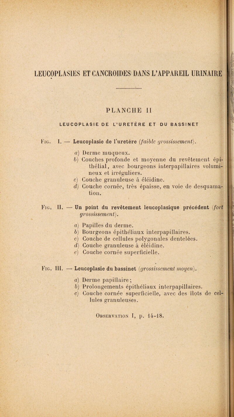 PLANCHE II LEUCOPLASIE DE L’URETÈRE ET DU BASSINET Fig. I. — Leucoplasie de l’uretère (faible grossissement). а) Derme muqueux. б) Couches profonde et moyenne du revêtement épi¬ thélial, avec bourgeons interpapillaires volumi¬ neux et irréguliers. c) Couche granuleuse à éléidine. d) Couche cornée, très épaisse, en voie de desquama¬ tion. Fig. II. — Un point du revêtement leucoplasique précédent (fort grossissement). a) Papilles du derme. b) Bourgeons épithéliaux interpapillaires. c) Couche de cellules polygonales dentelées. d) Couche granuleuse à éléidine. e) Couche cornée superficielle. Fig. III. — Leucoplasie du bassinet (grossissement moyen). а) Derme papillaire ; б) Prolongements épithéliaux interpapillaires. c) Couche cornée superficielle, avec des îlots de cel¬ lules granuleuses.