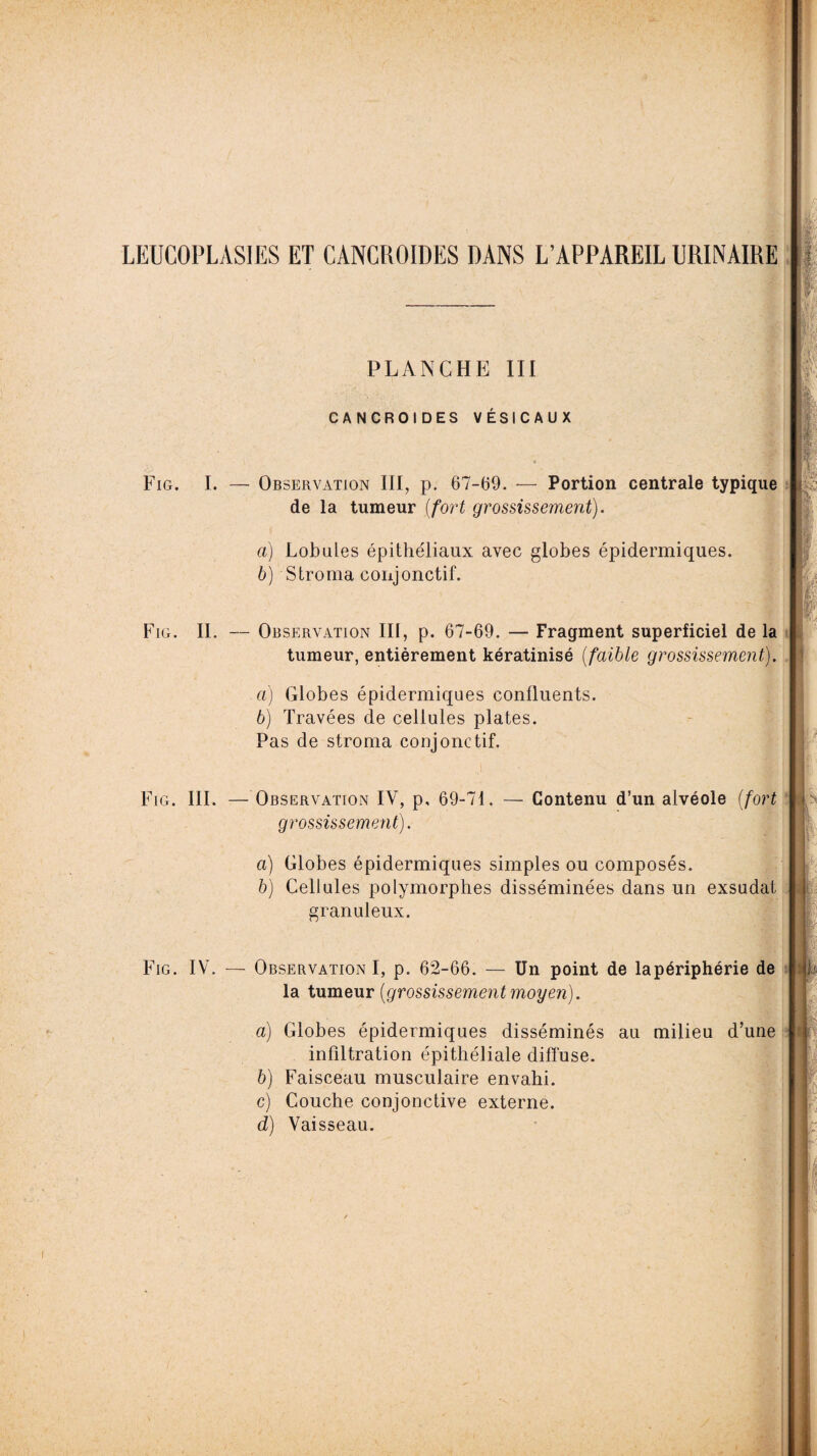 Fig. I. PLANCHE III CANCROIDES VÉSICAUX Ob servation III, p. 67-69. -— Portion centrale typique de la tumeur [fort grossissement). a) Lobules épithéliaux avec globes épidermiques. b) Stroma conjonctif. Fig. II. — Observation III, p. 67-69. — Fragment superficiel de la tumeur, entièrement kératinisé (faible grossissement). а) Globes épidermiques confluents. б) Travées de cellules plates. Pas de stroma conjonctif. Fig. III. Fig. IV. — Observation IV, p, 69-71. — Contenu d’un alvéole (fort grossissement). а) Globes épidermiques simples ou composés. б) Cellules polymorphes disséminées dans un exsudât granuleux. — Observation I, p. 62-66. — Un point de lapériphérie de la tumeur (grossissement moyen). a) Globes épidermiques disséminés au milieu d’une infiltration épithéliale diffuse. b) Faisceau musculaire envahi. c) Couche conjonctive externe. d) Vaisseau.